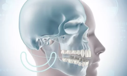 Çene daralması çapraz kapanmaya neden olabilir mi? - Milim Dental Hospital