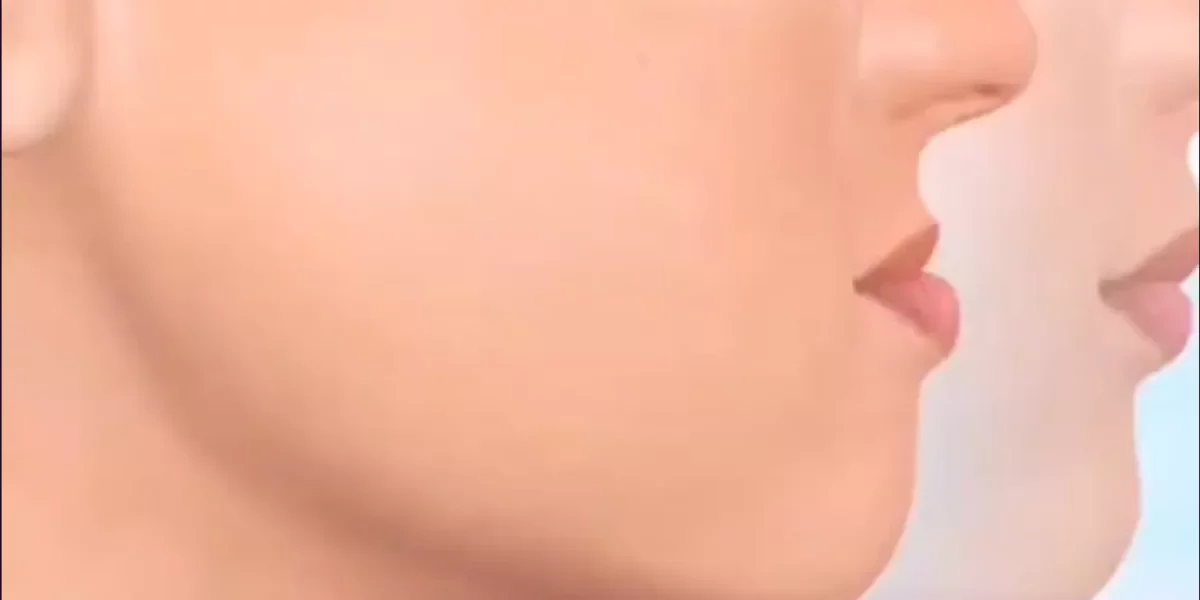 Çene Yapım Ortodontiyle Düzelir Mi, Yoksa Cerrahi Gerekir Mi?