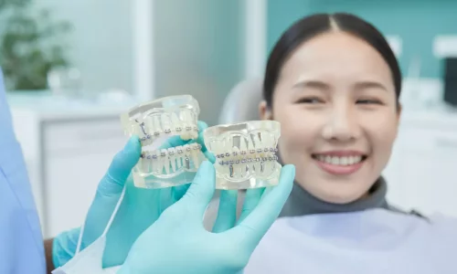 Seramik diş telleri metal diş telleri kadar etkili midir? - Milim Dental Hospital
