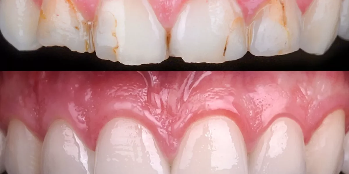 Hollywood Smile Her Zaman Veneer Midir?