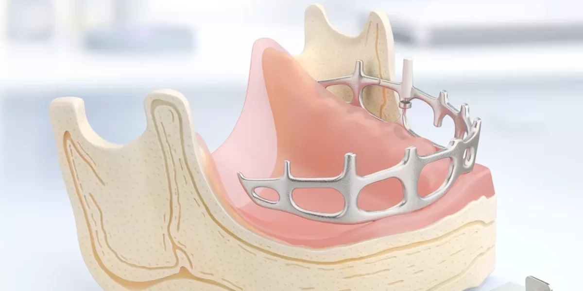 Subperiostal İmplantlar ve Şiddetli Kemik Kaybı