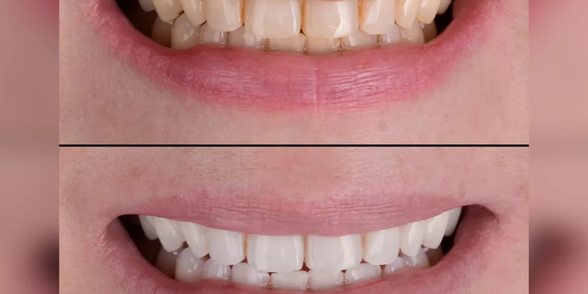 Günlük Ağız Sağlığınız İçin Eksiksiz Rehber – Dolgulardan Beyazlatmaya