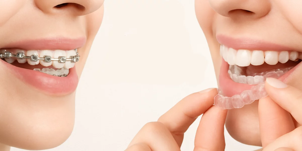 Diş Telleri veya Invisalign?