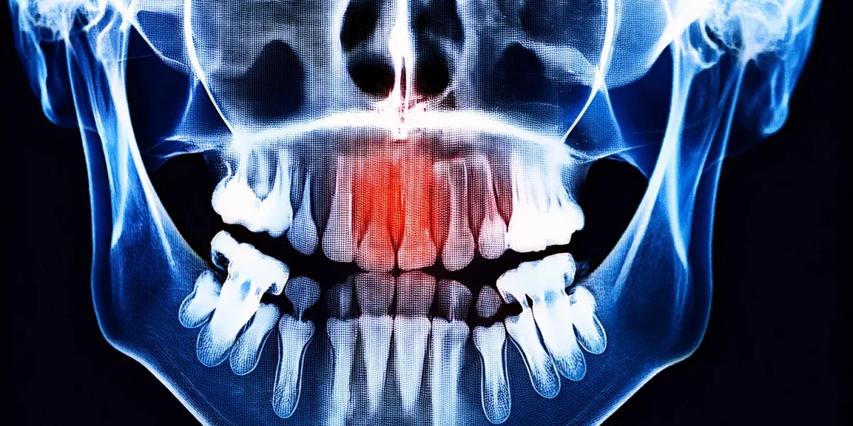 ÇENE KİSTİ veya TÜMÖR mü? Panoramik Röntgendeki 