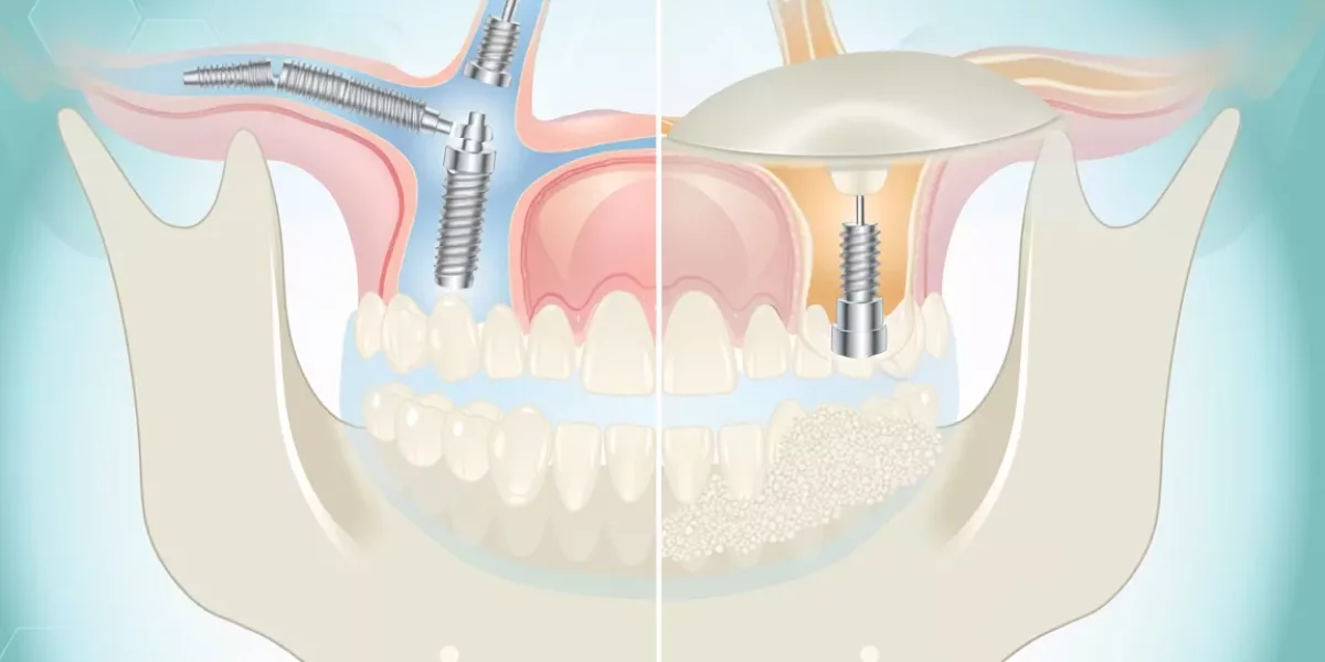 Zygoma İmplantları ve Sinüs Kaldırma Karşılaştırması