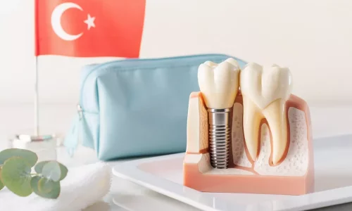 Türkiye'de İmplant Sonrası Bakım Rehberi - Milim Dental Hospital