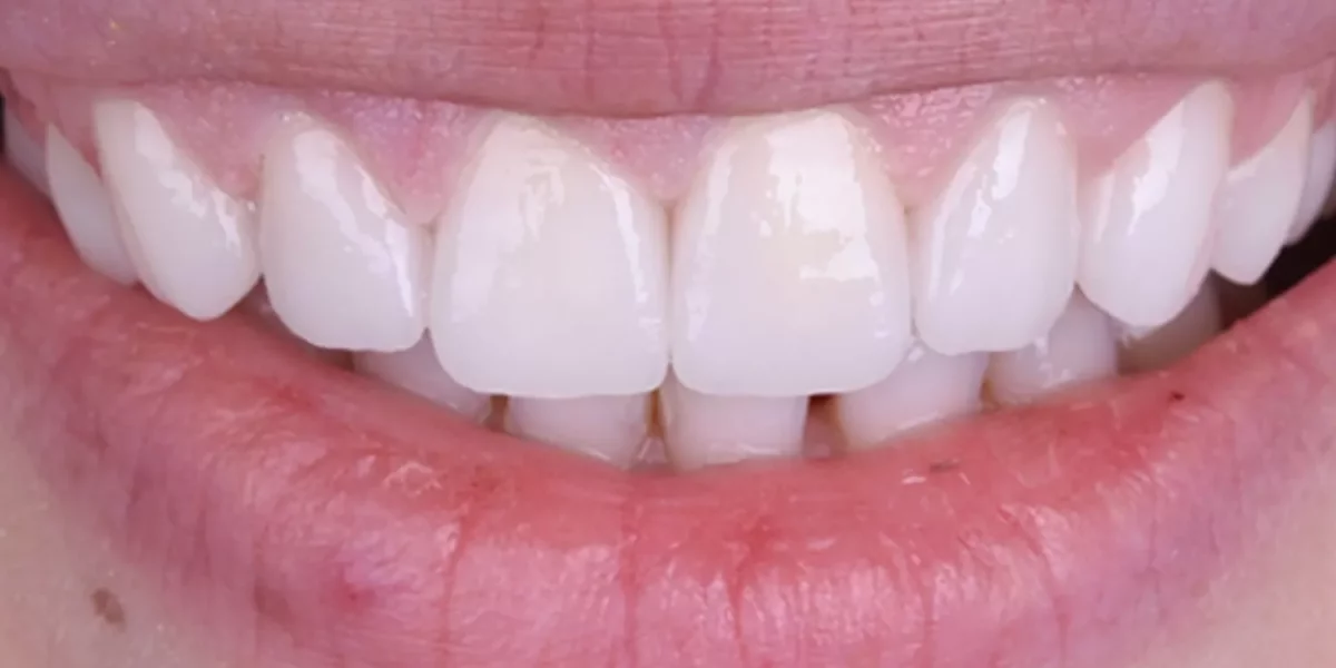 Doğal Görünümlü Hollywood Smile: Amerikan Hastaların Bilmesi Gerekenler