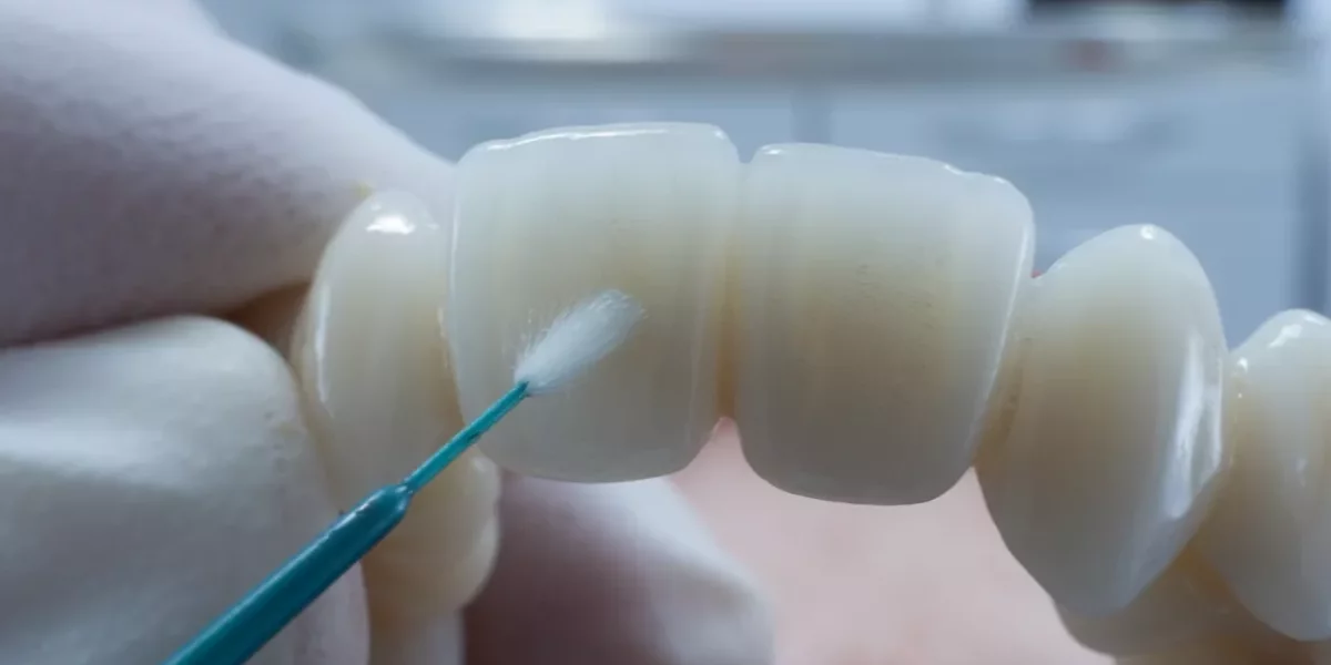 Veneer Bağlama Protokolü Dayanıklılığı: Veneerlerin Uzun Ömürlü Olmasını Sağlayan Nedir