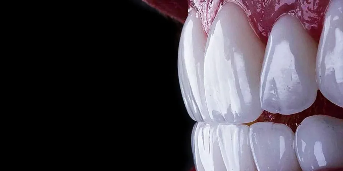 Bir Yıldız Gibi Parlayın: Bursa Milim Dental'da E-Max Veneer ile Hollywood Smile