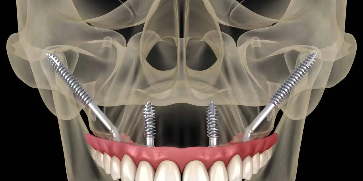 Kemik Kaybı Olan Hastalar İçin All-on-X’in Avantajları