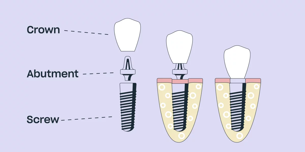 All-on-X Prosedürü: Adım Adım Rehber