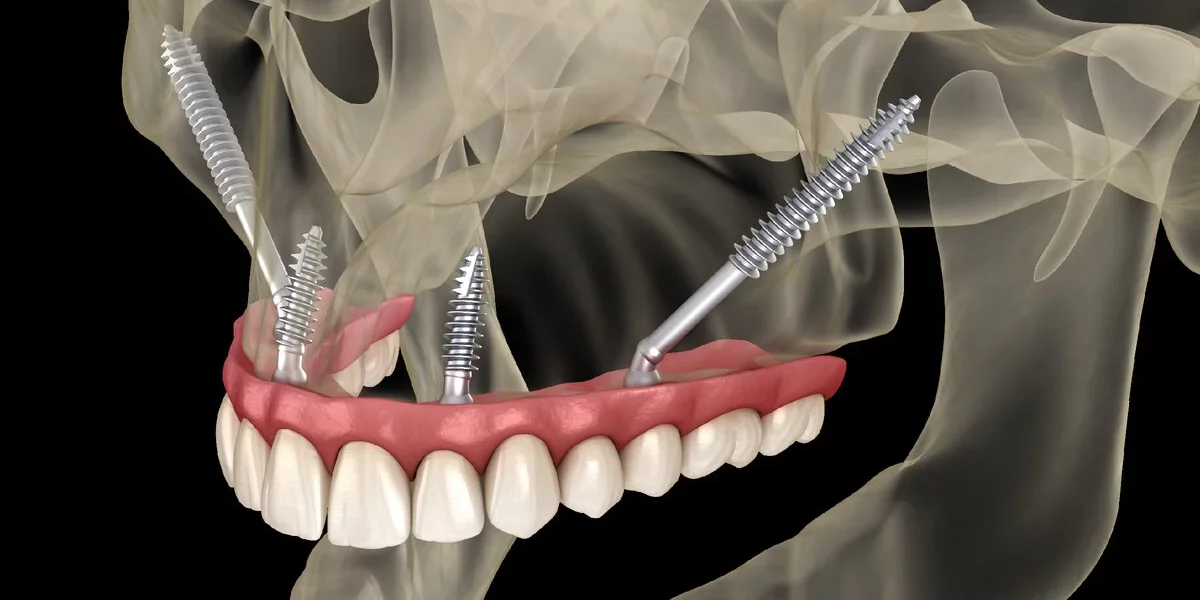 Zygomatik İmplant İşlemi: Cerrahi ve İyileşme Açıklaması