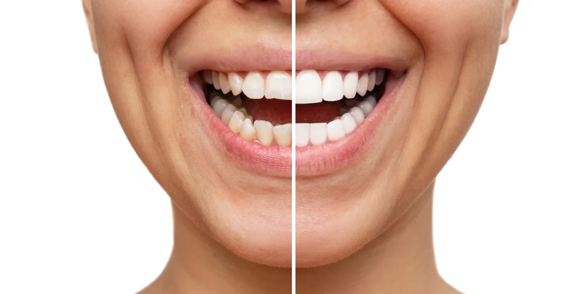 Kaplamalar Nedir ve Gülüşünüzü Nasıl Dönüştürebilir?