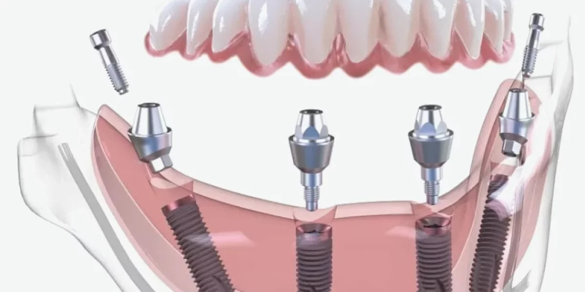 All-on-X Nedir ve All-on-4'ten Nasıl Farklıdır?