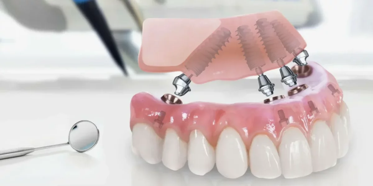 All-on-4 Tekniği Nedir?