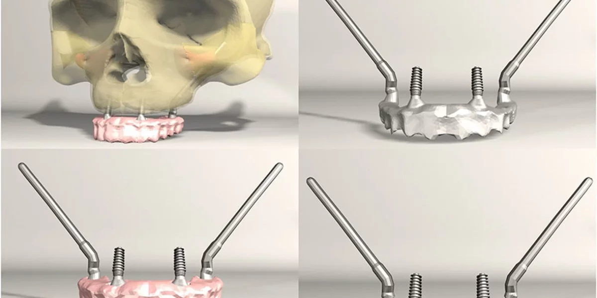 Diş İmplantlarının Mümkün Olmadığı Durumlarda, Zygomatik İmplantlar Çözümdür – Sadece Milim Dental, Bursa’da