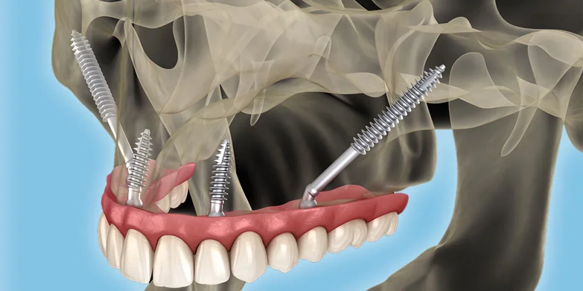 Zygomatic İmplantlar: Şiddetli Kemik Kaybında Son Umut – Milim Dental’ın Türkiye’deki Uzmanlığı