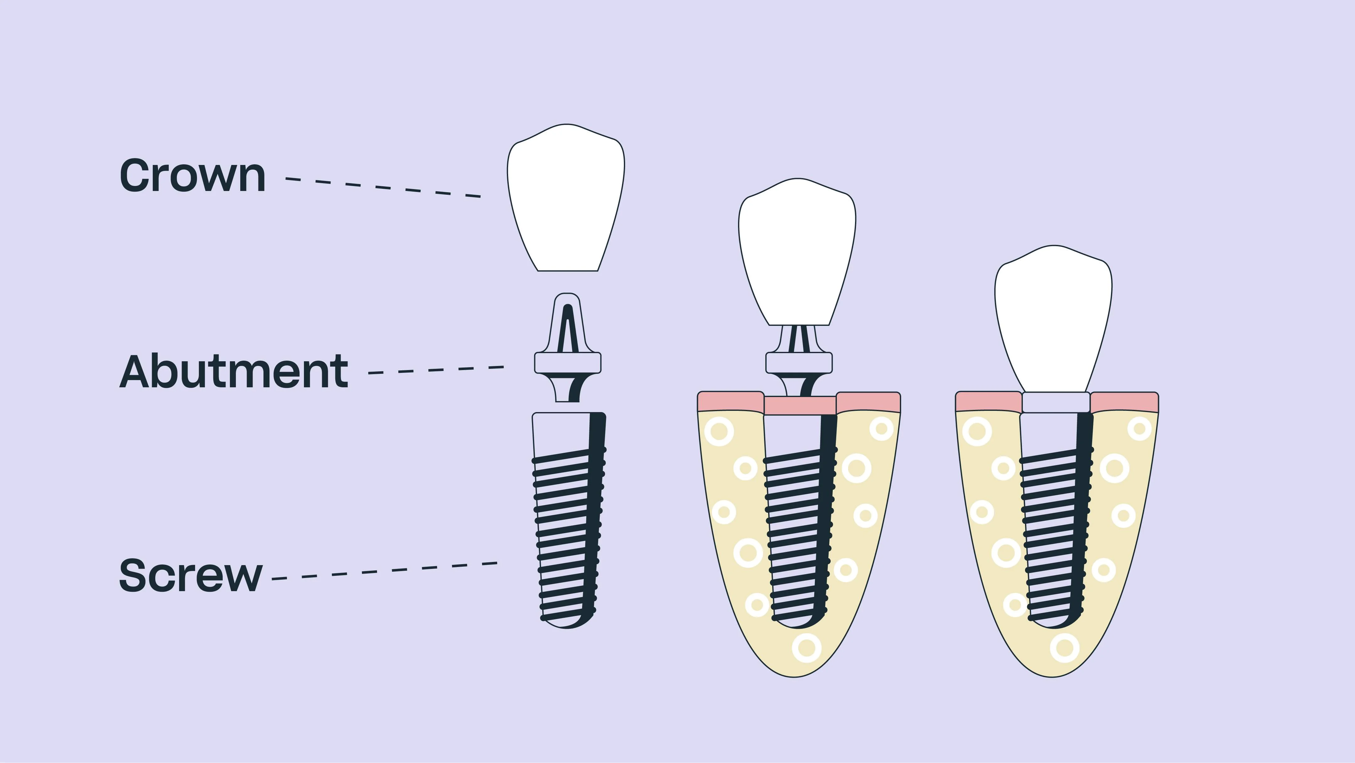 All-on-X Prosedürü: Adım Adım Rehber