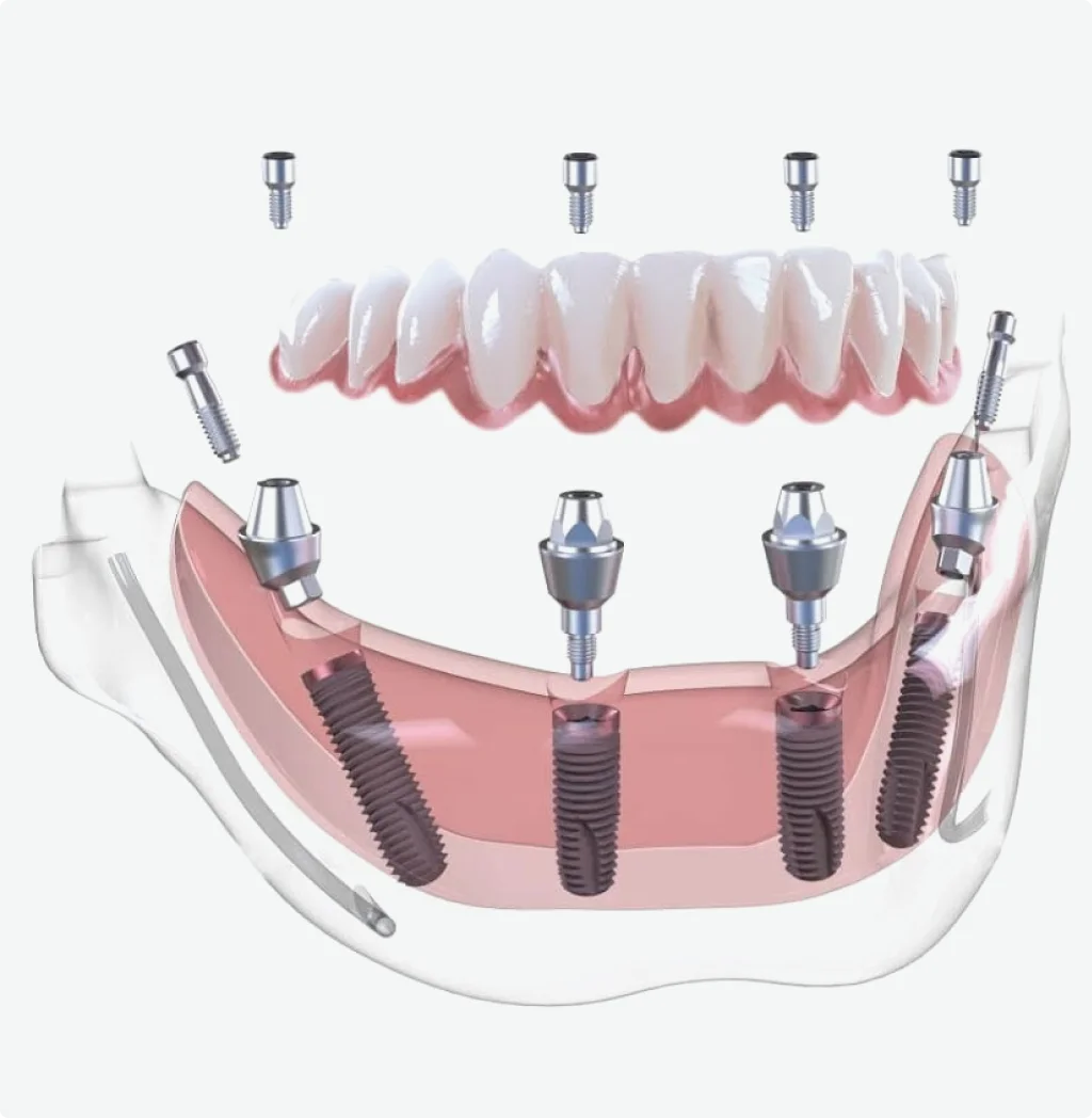 All-on-X Nedir ve All-on-4'ten Nasıl Farklıdır?