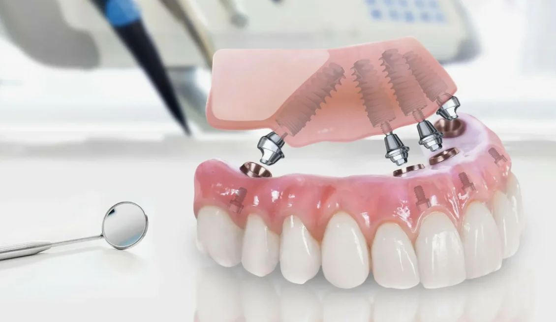 All-on-4 Tekniği Nedir?