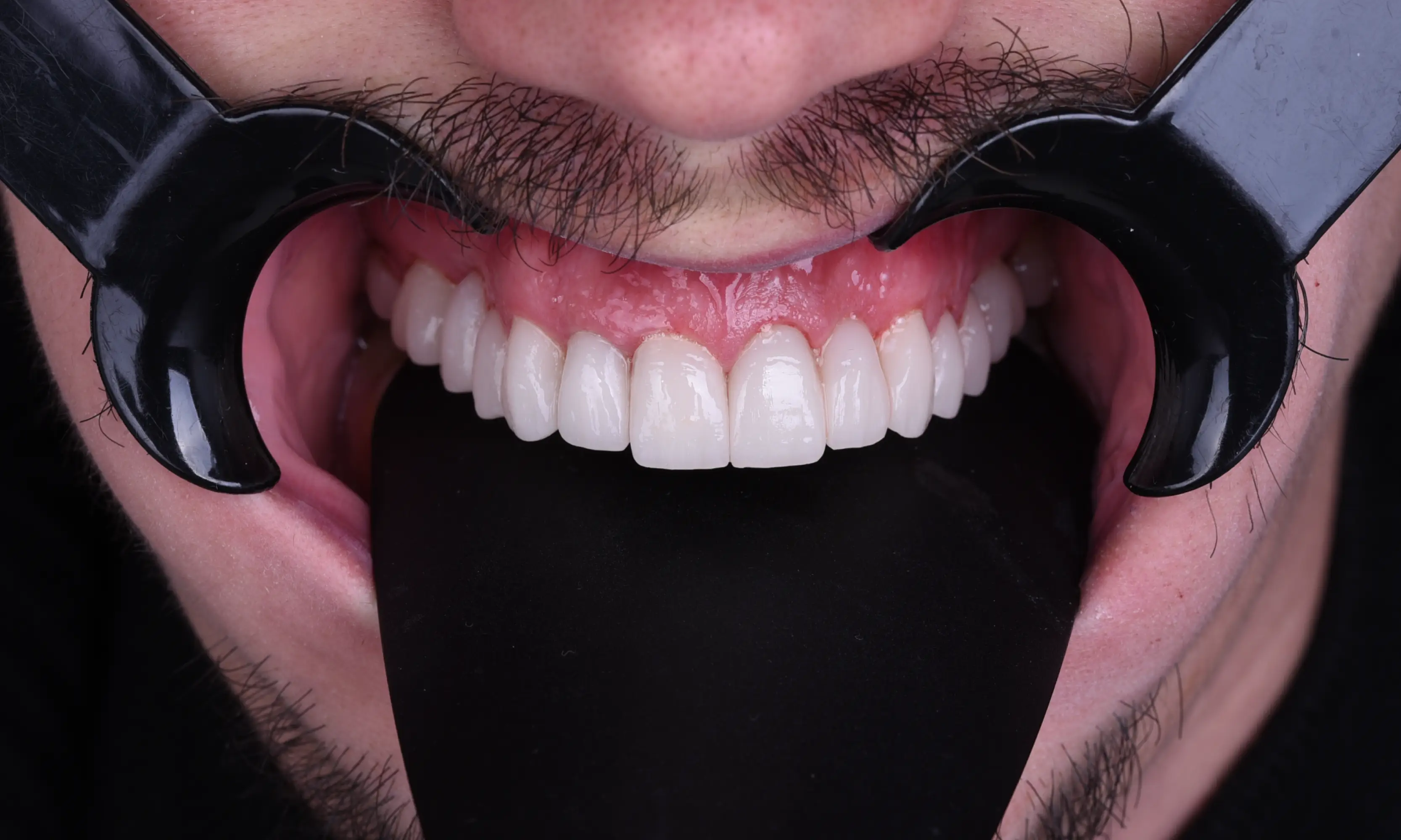 İmplant Sonrası - Vaka 17 - Milim Dental Hospital Bursa
