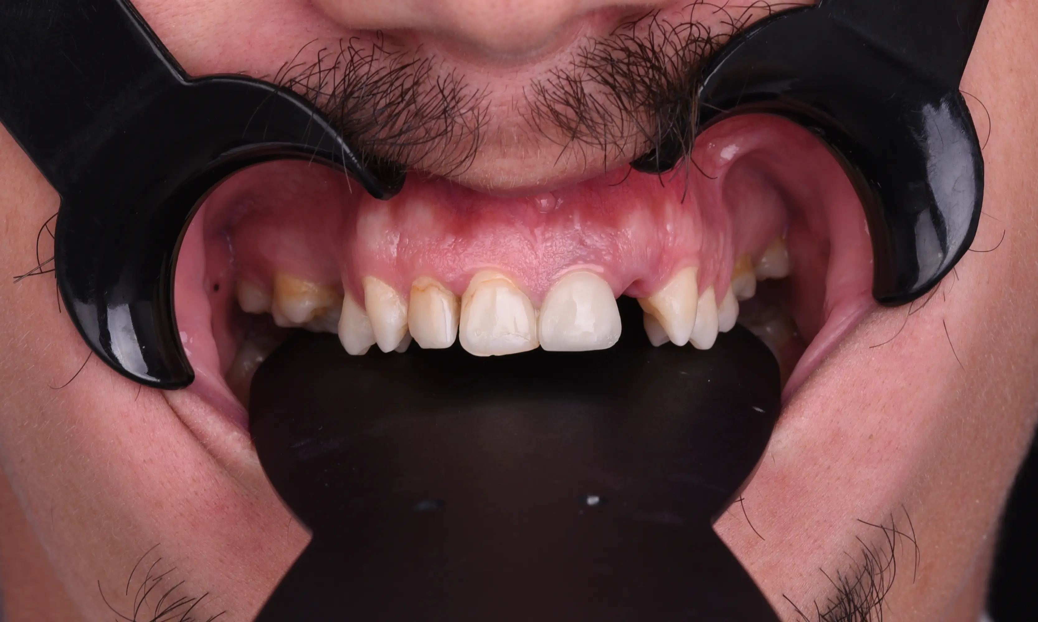 İmplant Öncesi - Vaka 17 - Milim Dental Hospital Bursa