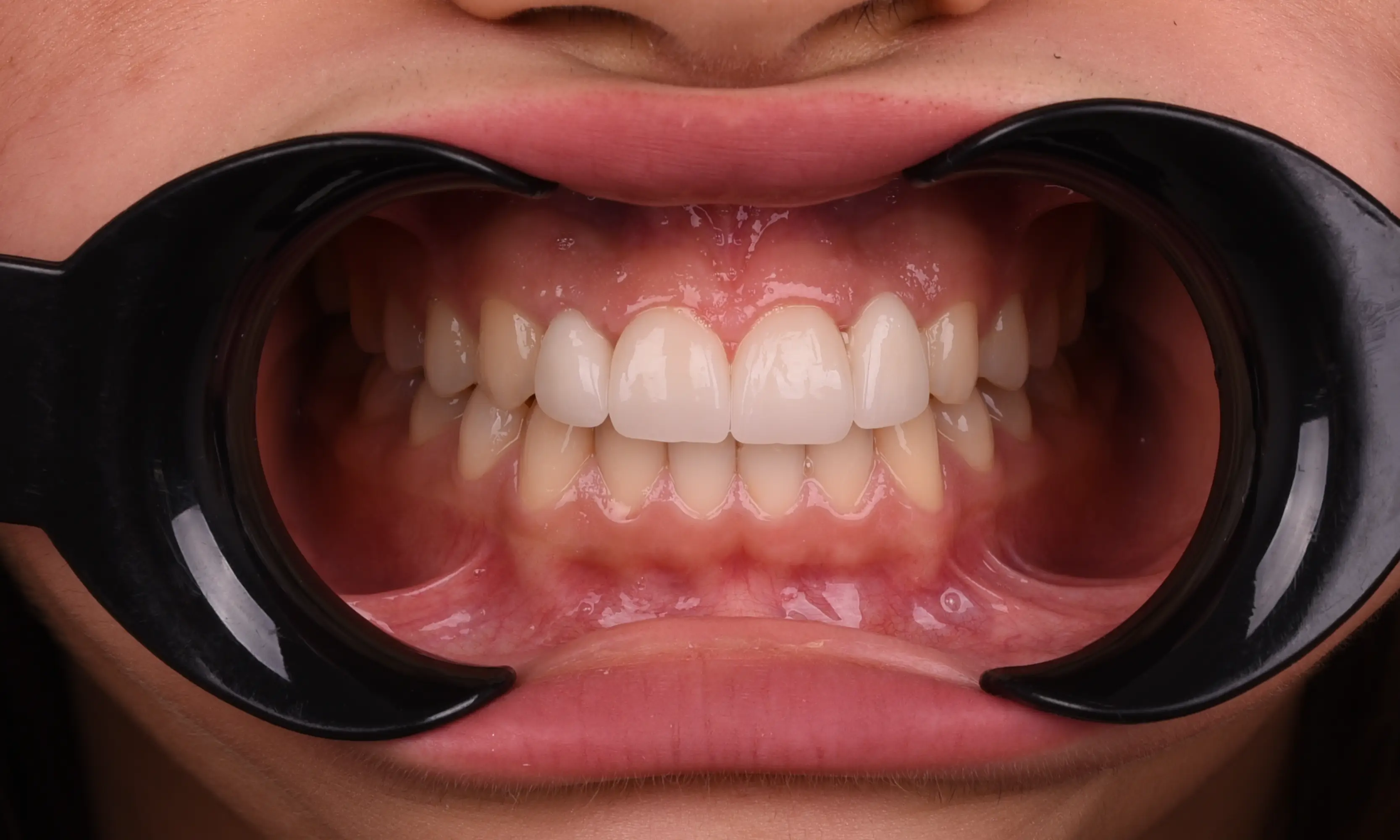 İmplant Sonrası - Vaka 23 - Milim Dental Hospital Bursa