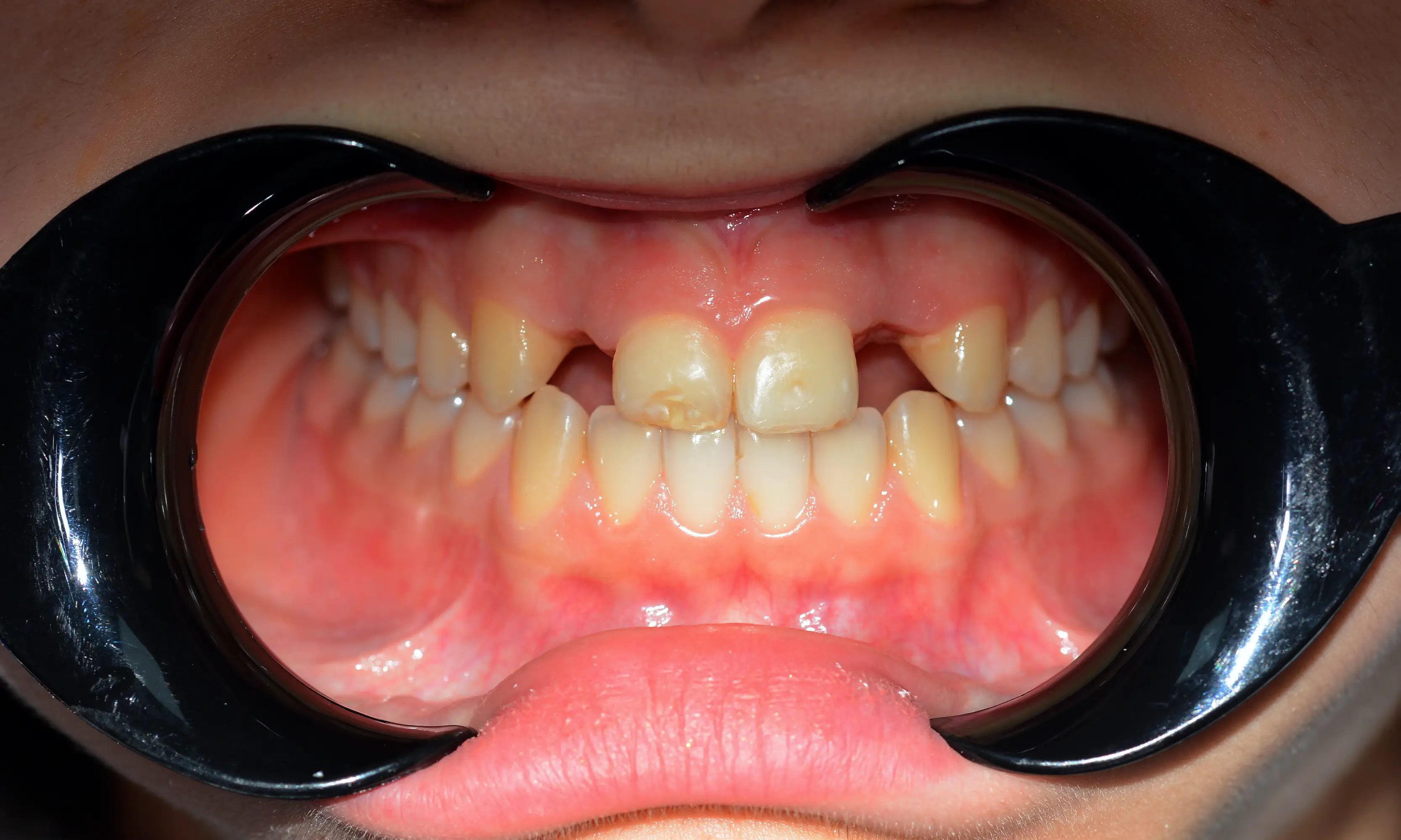 İmplant Öncesi - Vaka 23 - Milim Dental Hospital Bursa