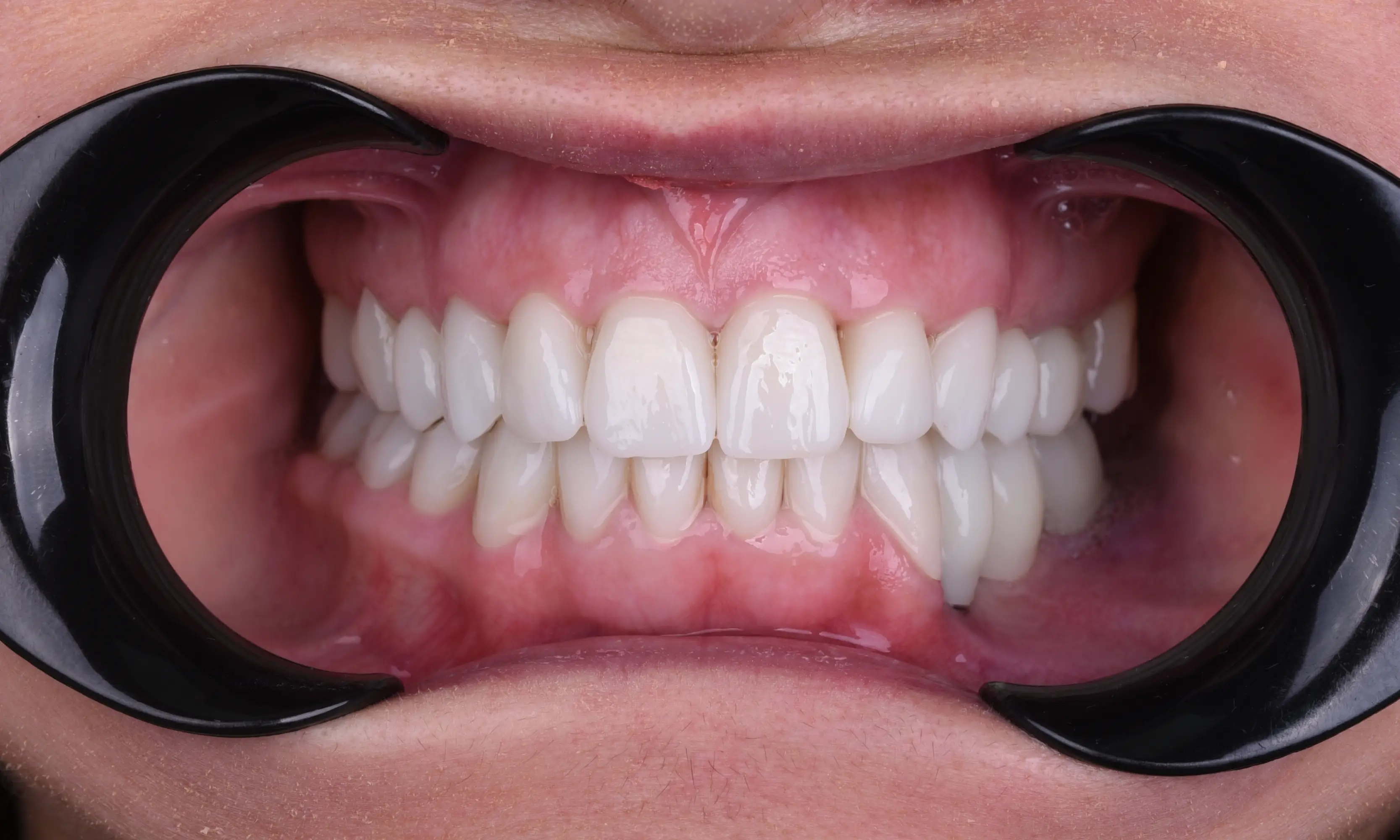 İmplant Sonrası - Vaka 26 - Milim Dental Hospital Bursa