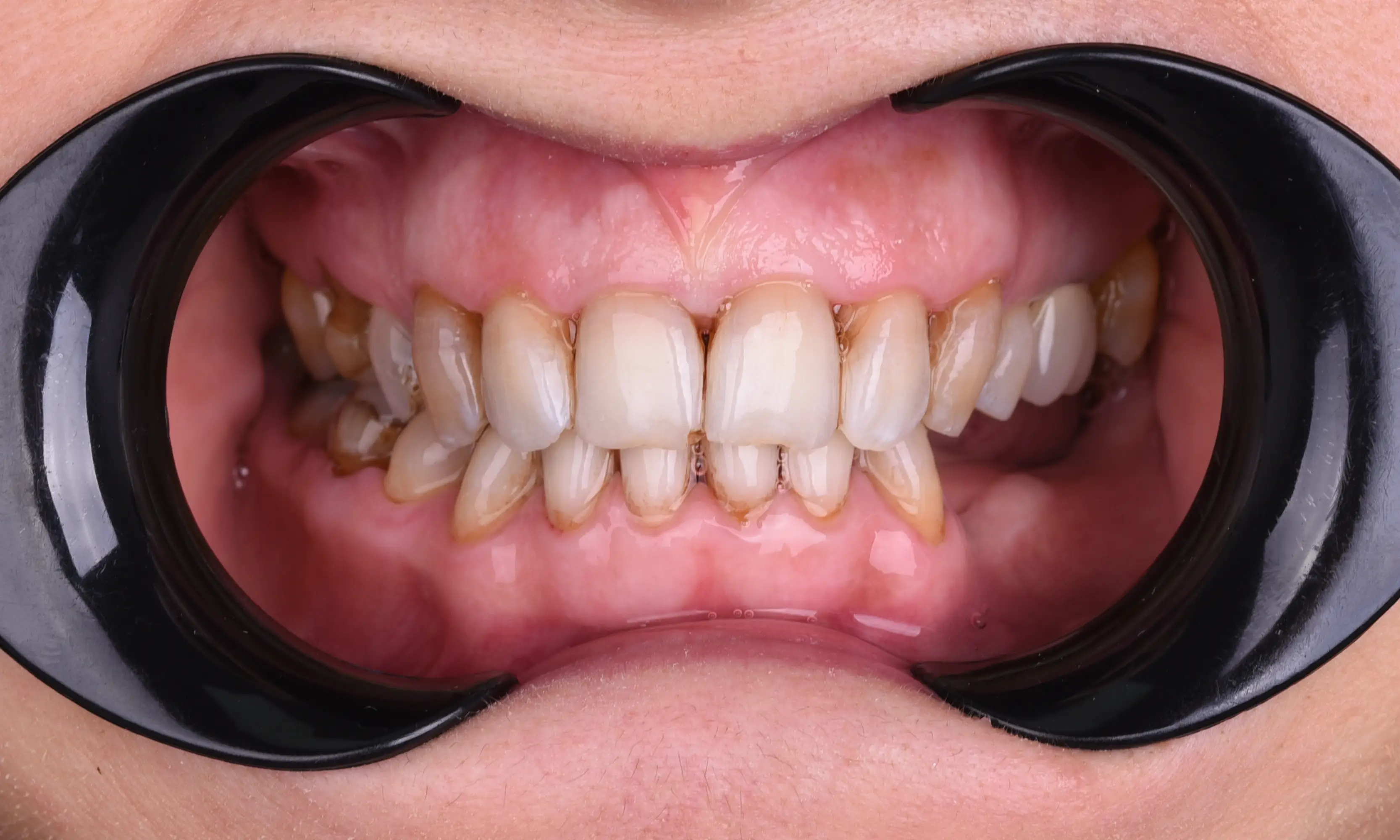 İmplant Öncesi - Vaka 26 - Milim Dental Hospital Bursa