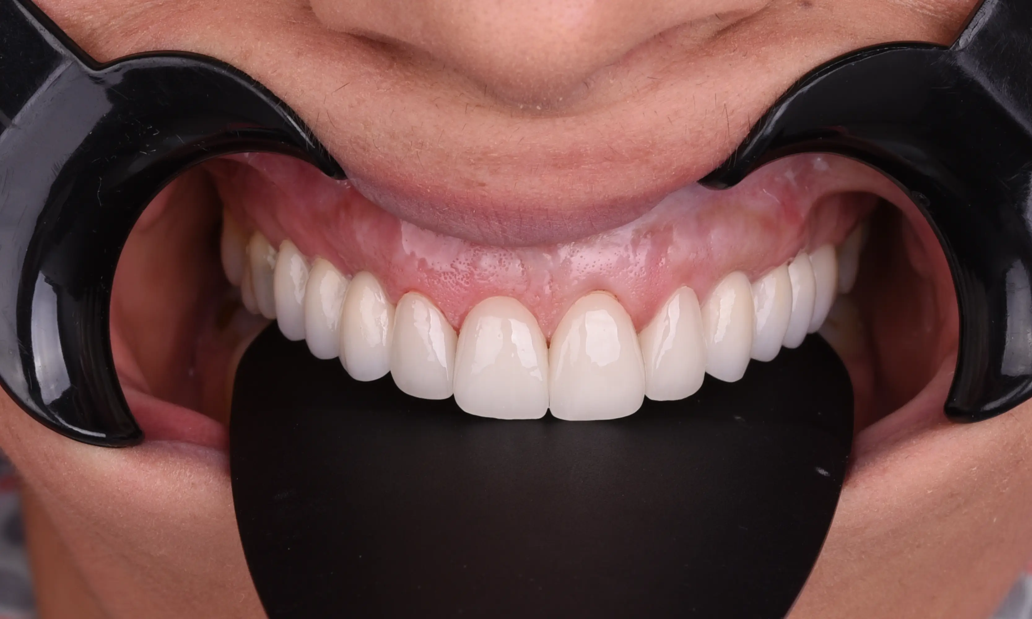 Full Veneers Sonrası - Vaka 35 - Milim Dental Hospital Bursa
