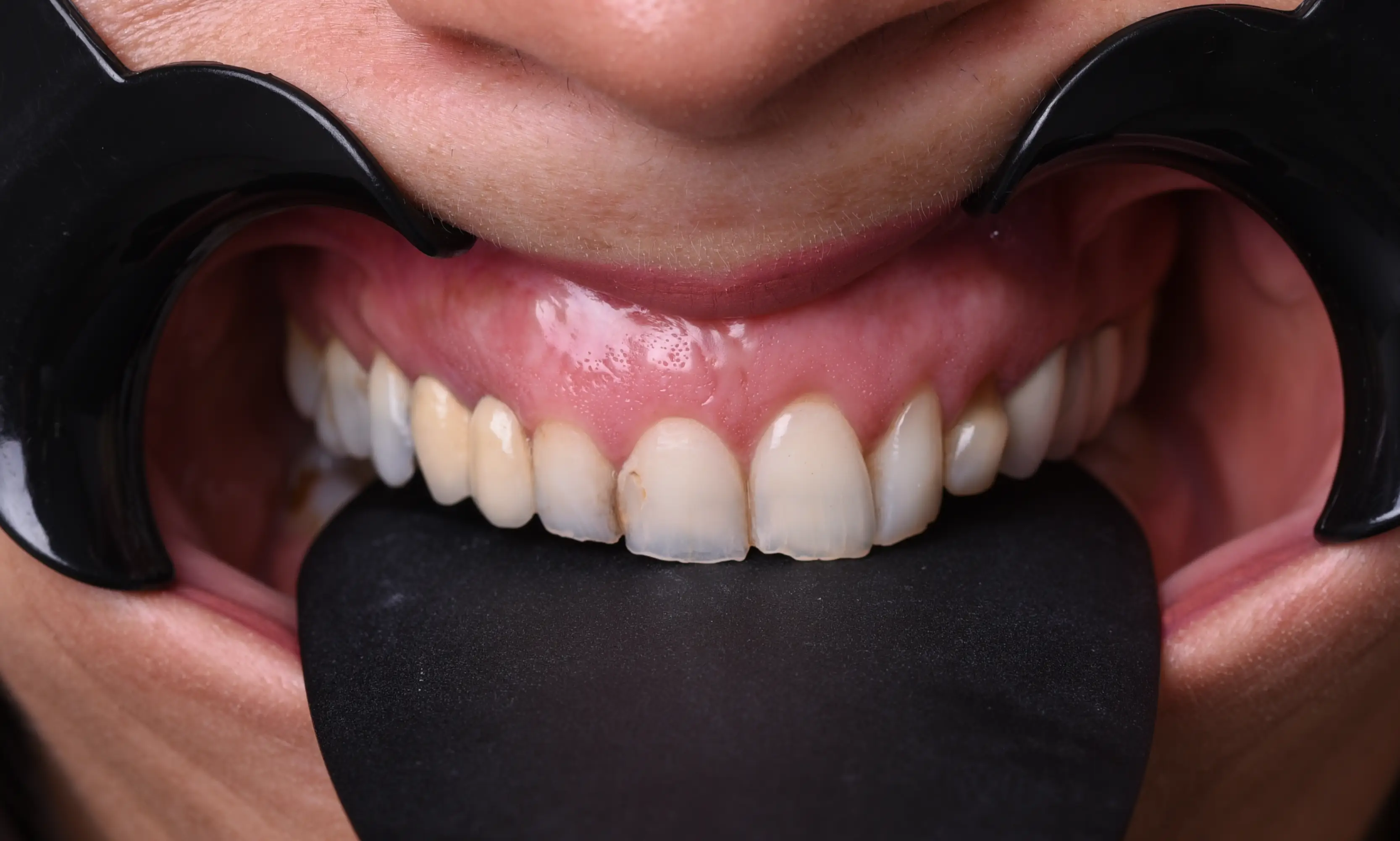 Full Veneers Öncesi - Vaka 35 - Milim Dental Hospital Bursa