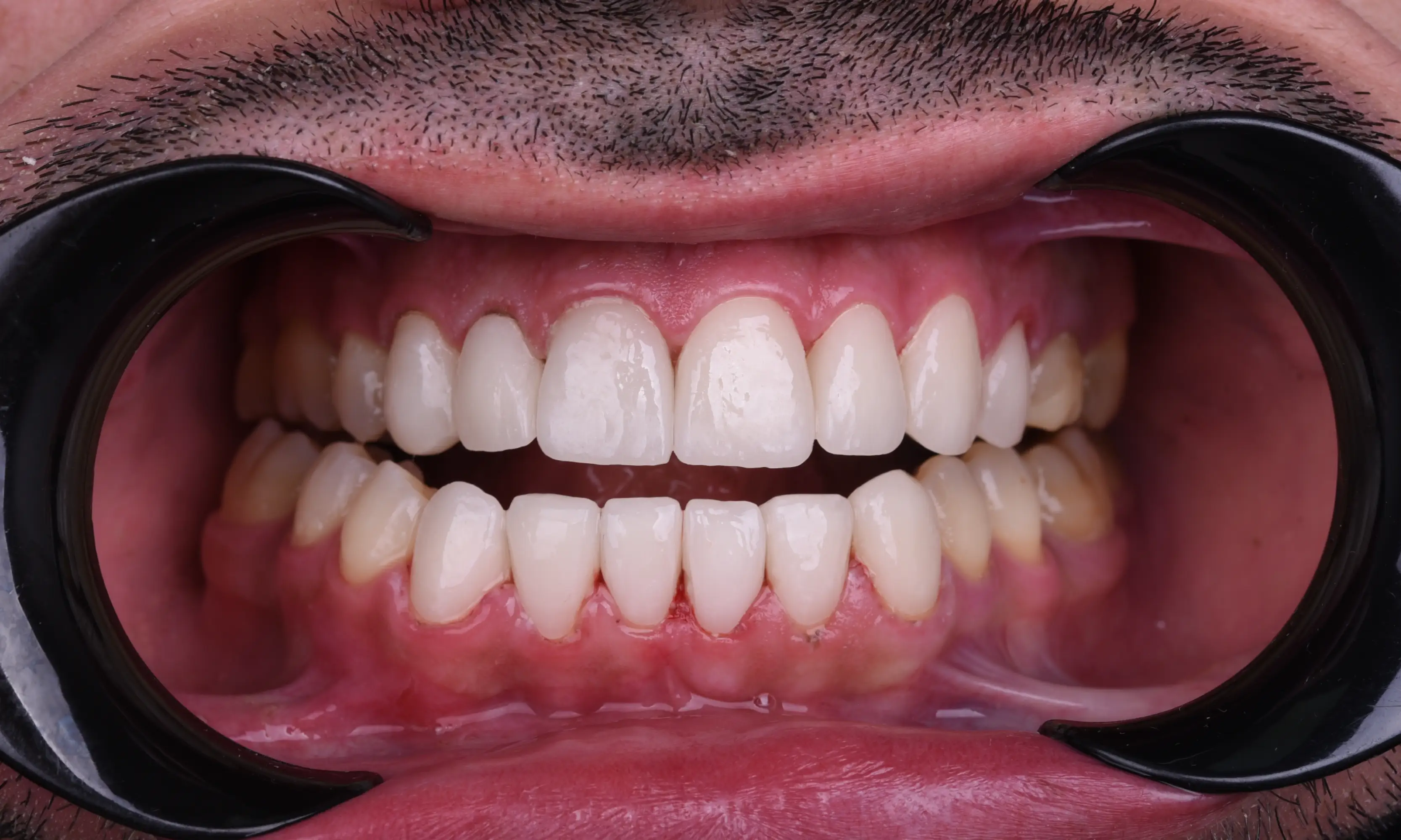 Full Veneers Sonrası - Vaka 36 - Milim Dental Hospital Bursa