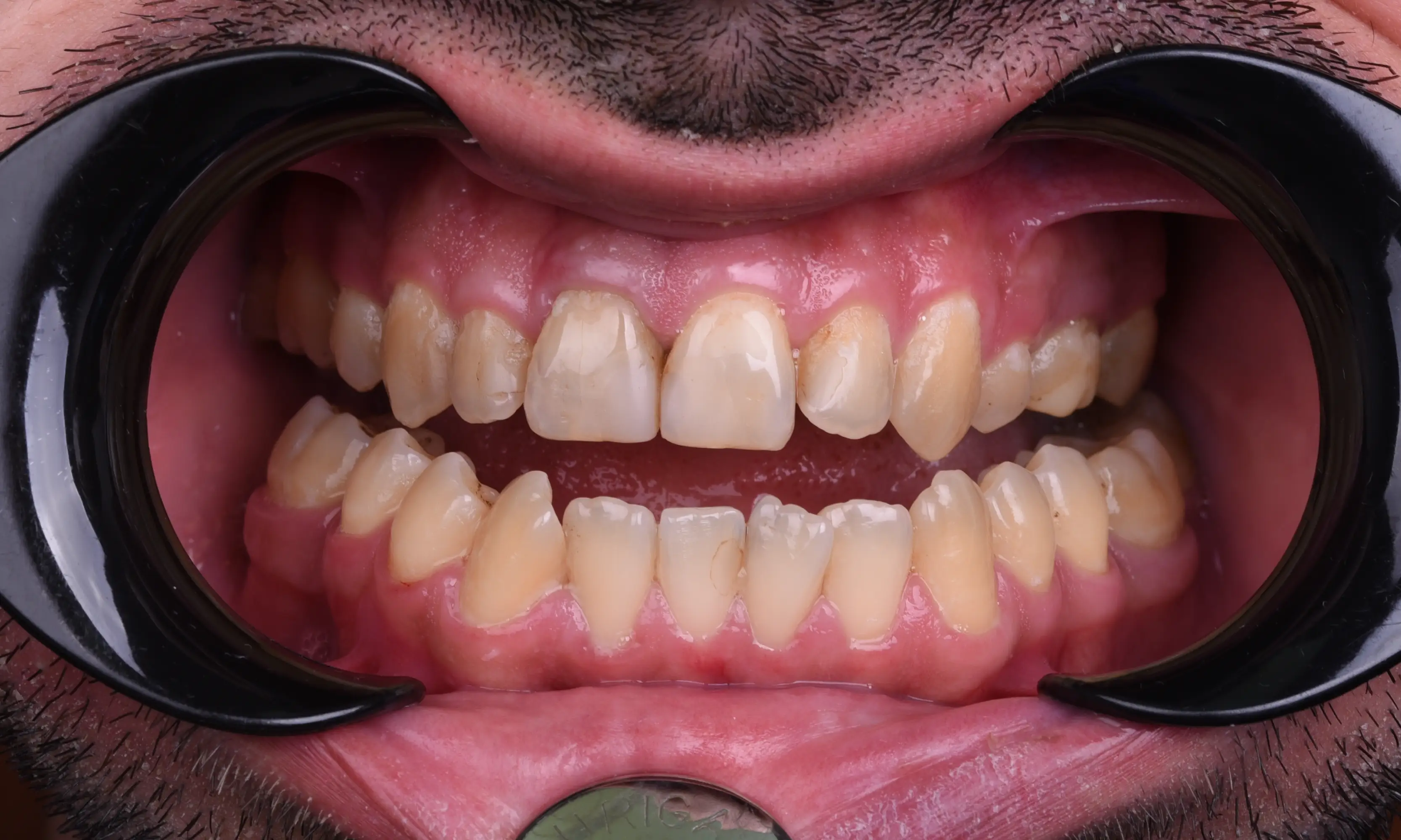 Full Veneers Öncesi - Vaka 36 - Milim Dental Hospital Bursa