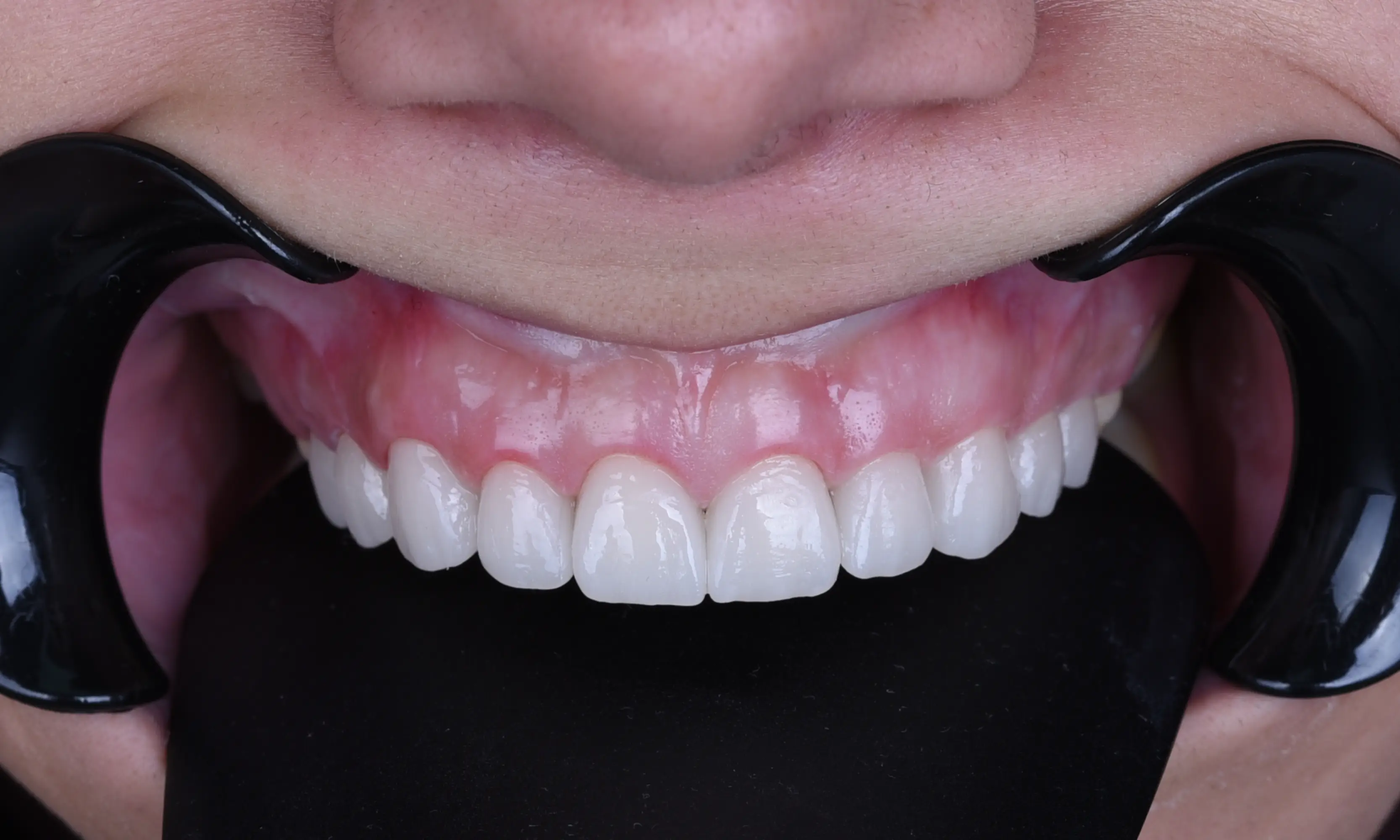Full Veneers Sonrası - Vaka 39 - Milim Dental Hospital Bursa