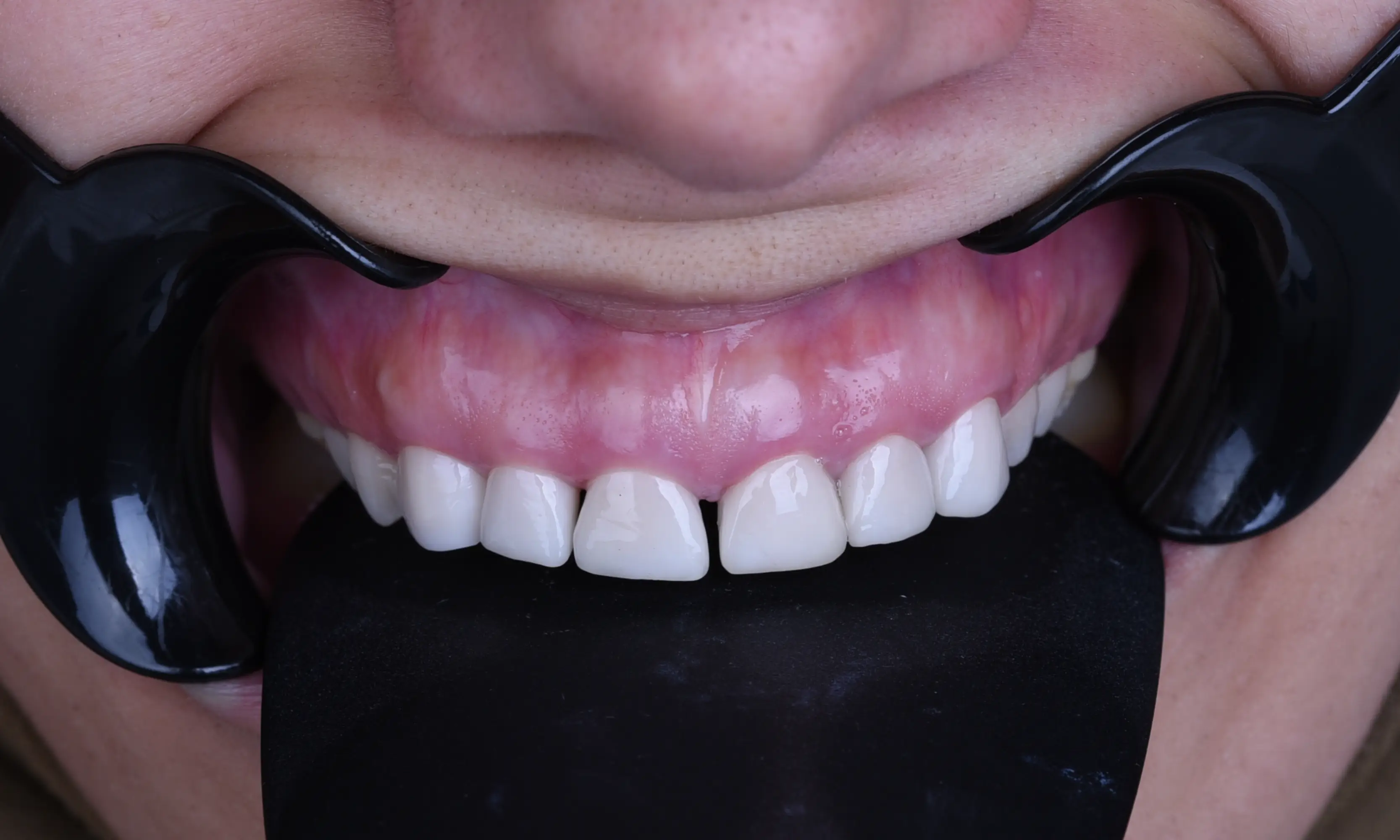 Full Veneers Öncesi - Vaka 39 - Milim Dental Hospital Bursa