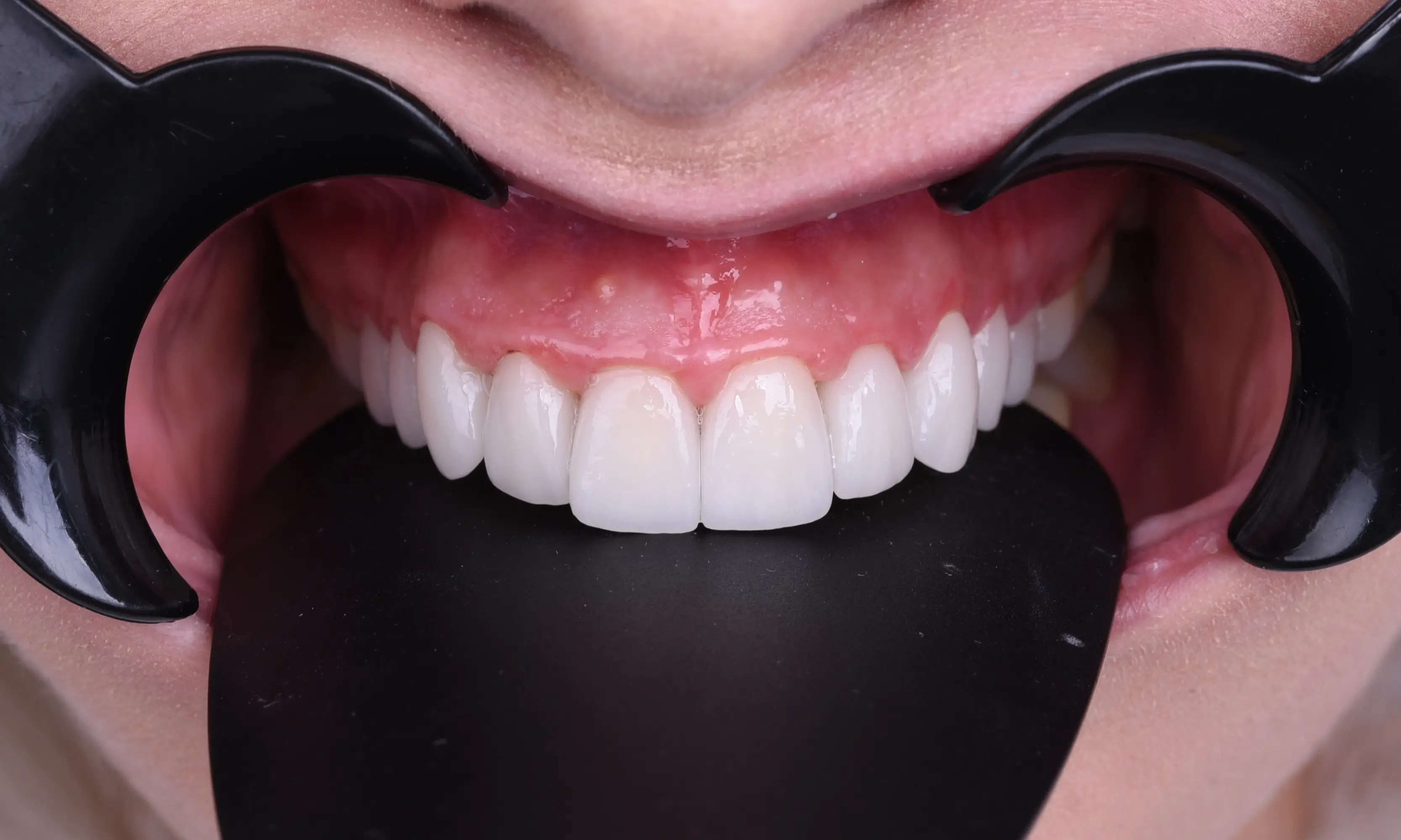 Full Veneers Sonrası - Vaka 51 - Milim Dental Hospital Bursa