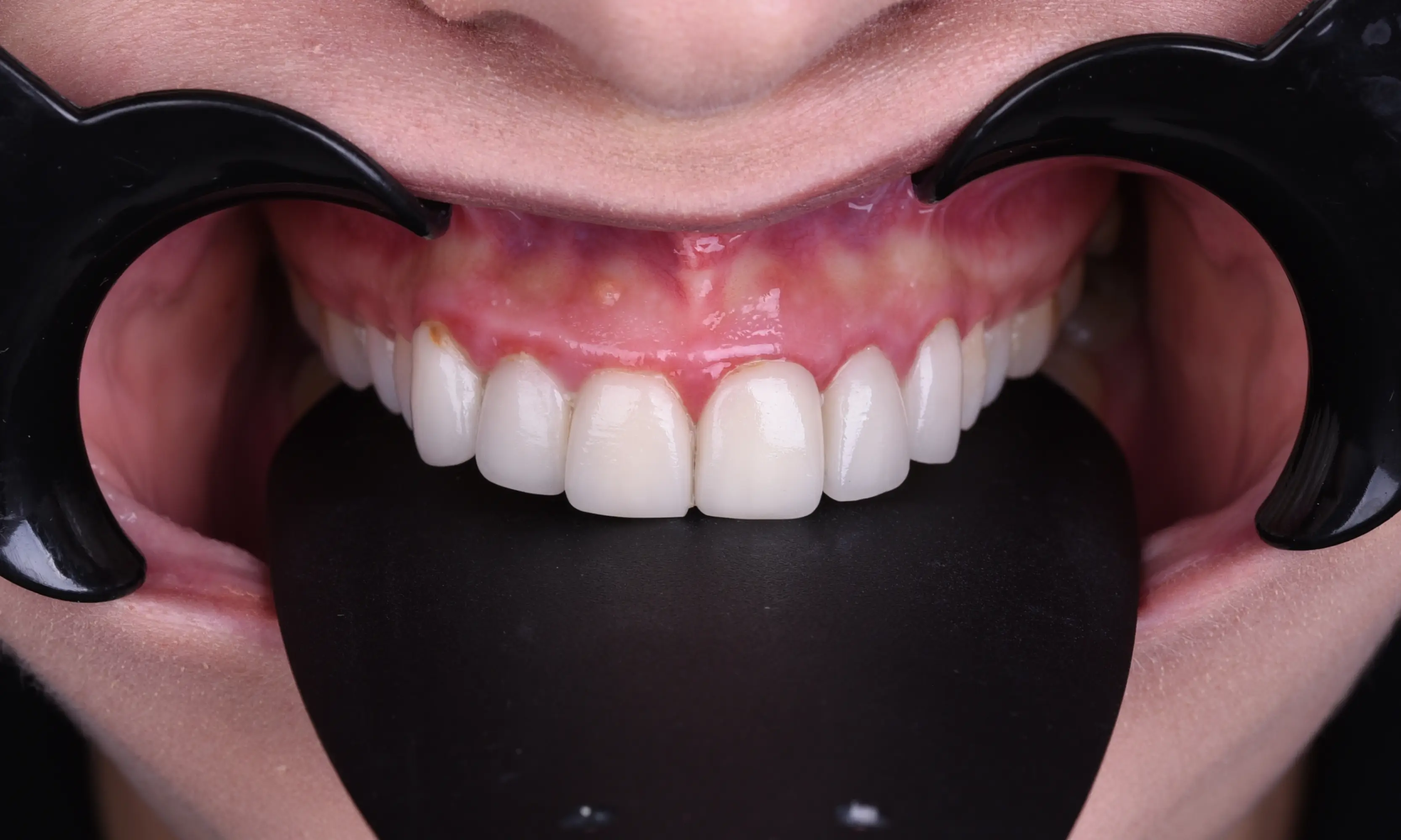 Full Veneers Öncesi - Vaka 51 - Milim Dental Hospital Bursa