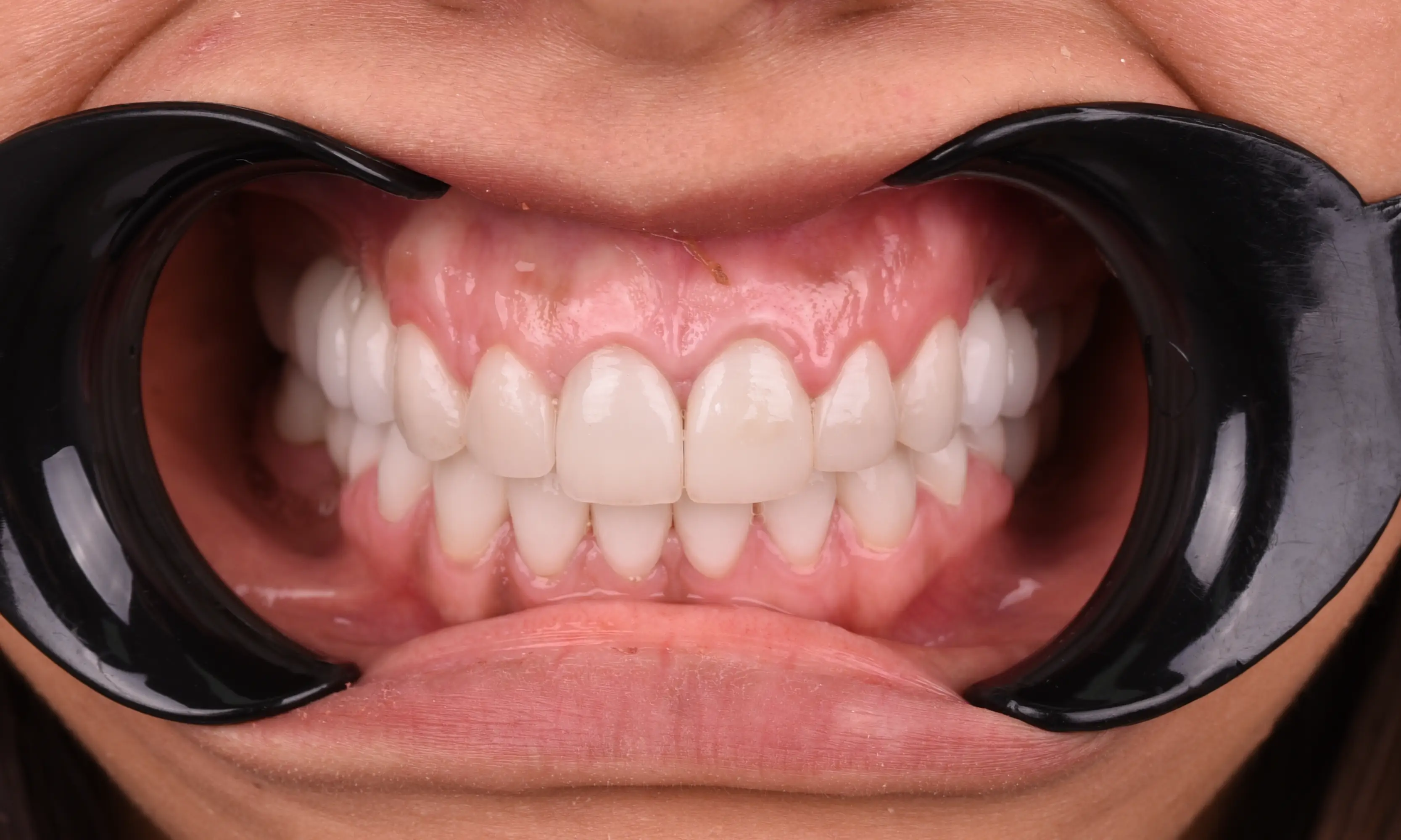 Full Veneers Sonrası - Vaka 52 - Milim Dental Hospital Bursa