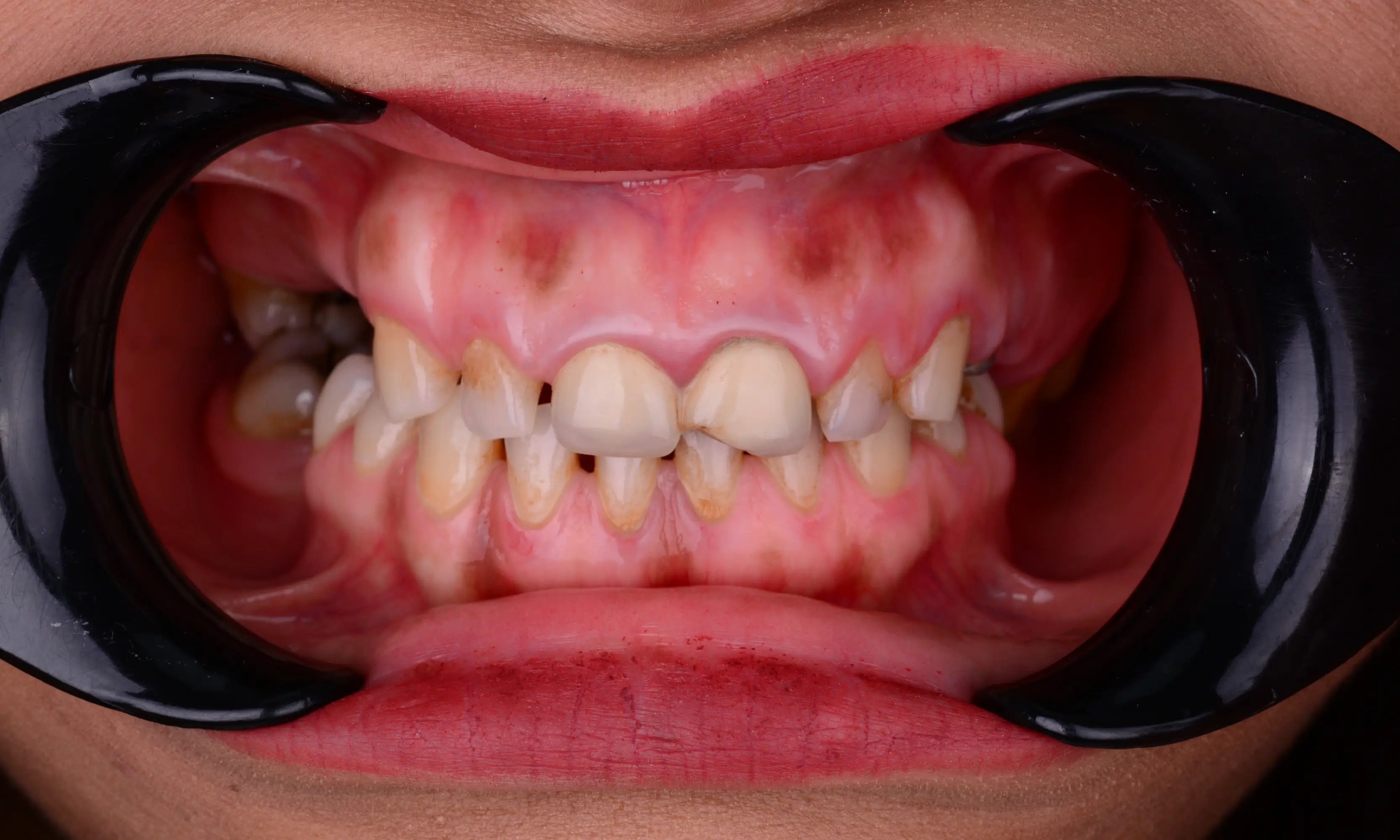 Full Veneers Öncesi - Vaka 52 - Milim Dental Hospital Bursa