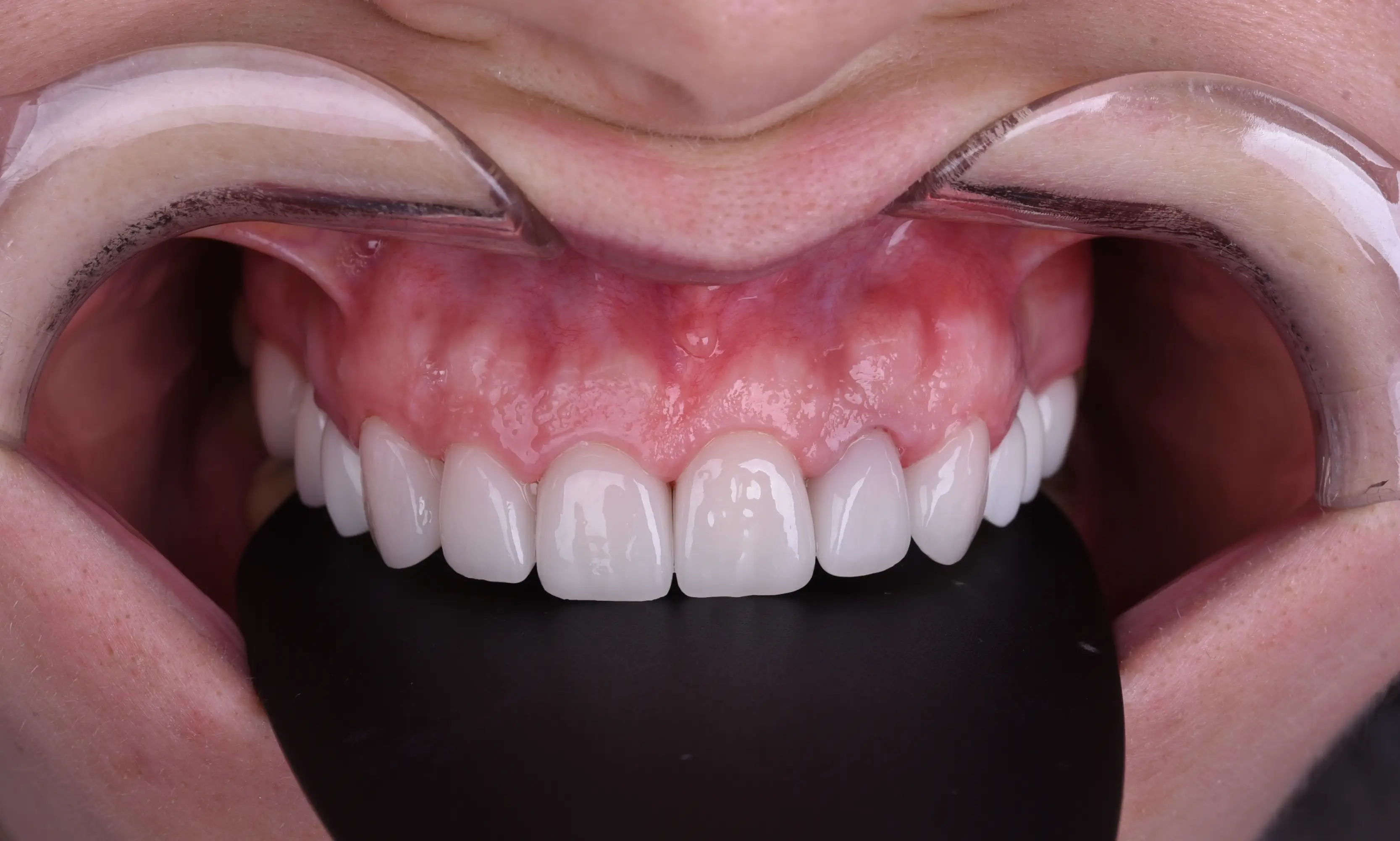 Tam Zirkonyum Sonrası - Vaka 54 - Milim Dental Hospital Bursa