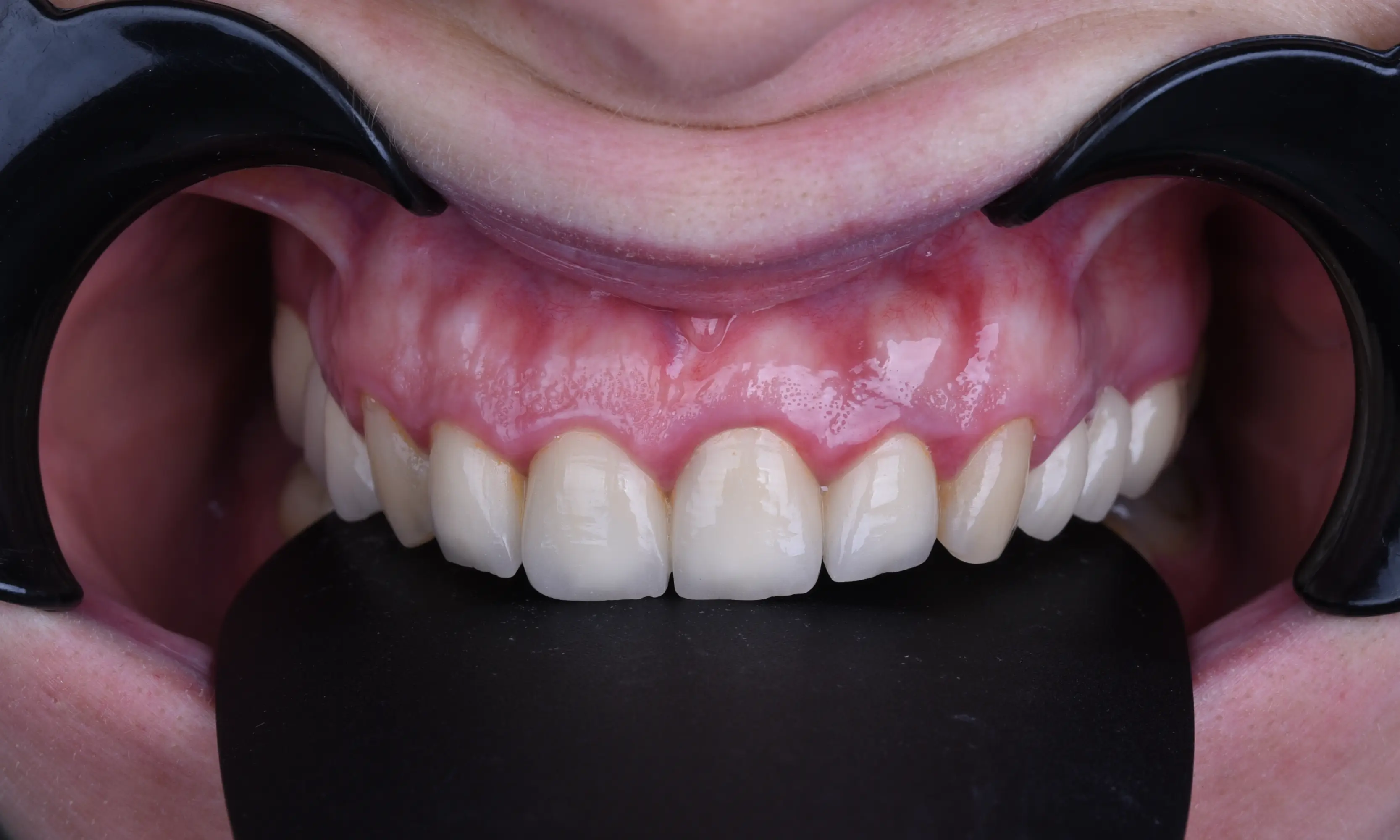 Tam Zirkonyum Öncesi - Vaka 54 - Milim Dental Hospital Bursa