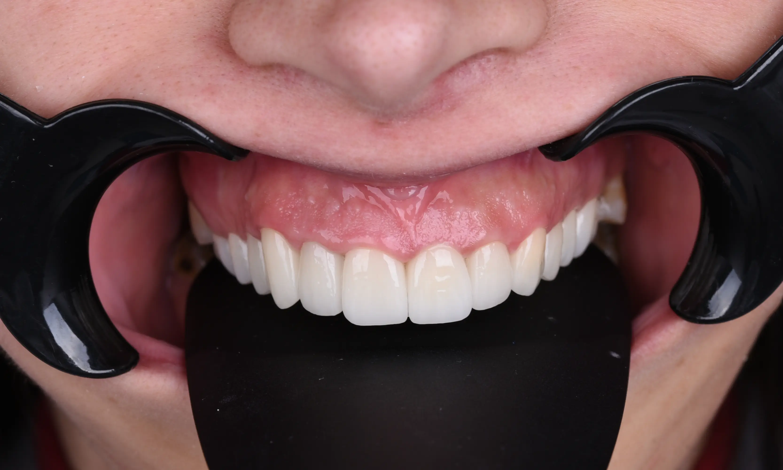 Tam Zirkonyum Sonrası - Vaka 55 - Milim Dental Hospital Bursa