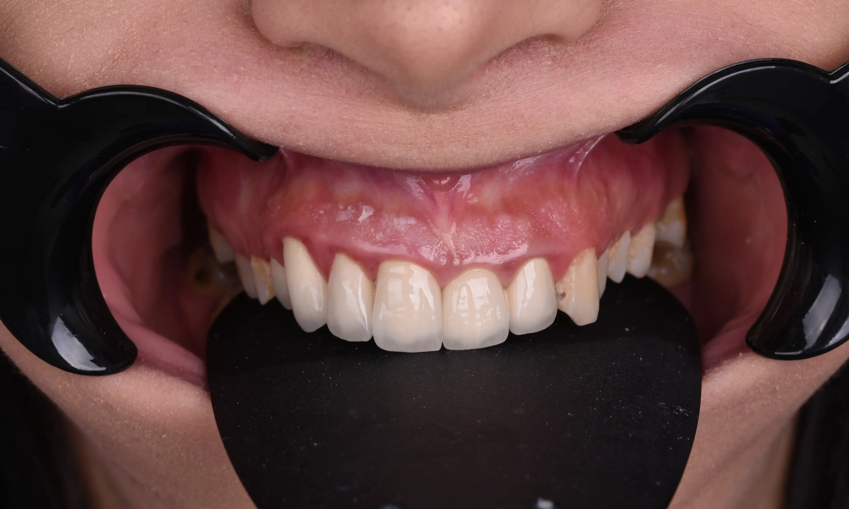 Tam Zirkonyum Öncesi - Vaka 55 - Milim Dental Hospital Bursa