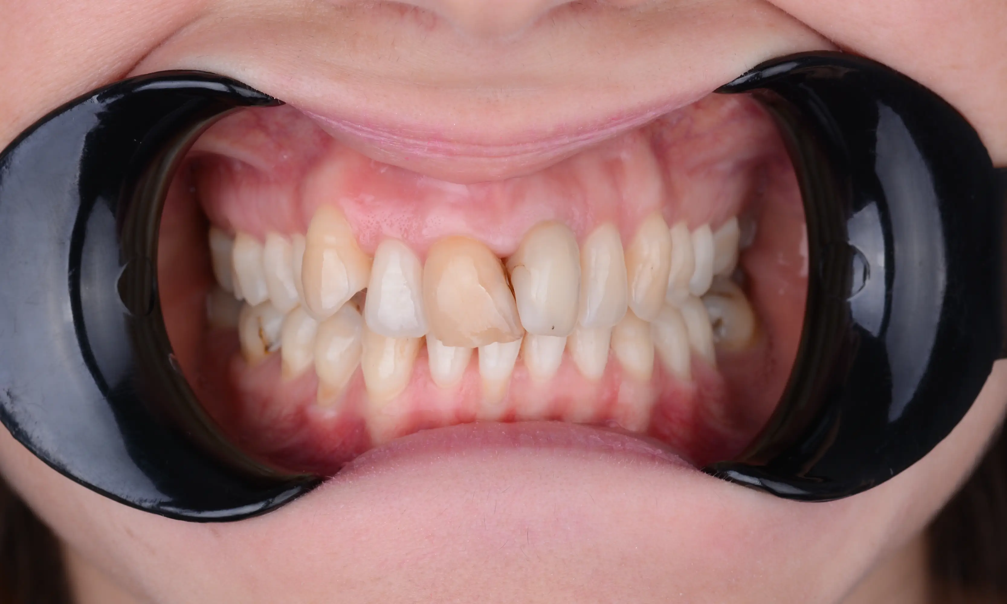 Tam Zirkonyum Öncesi - Vaka 57 - Milim Dental Hospital Bursa
