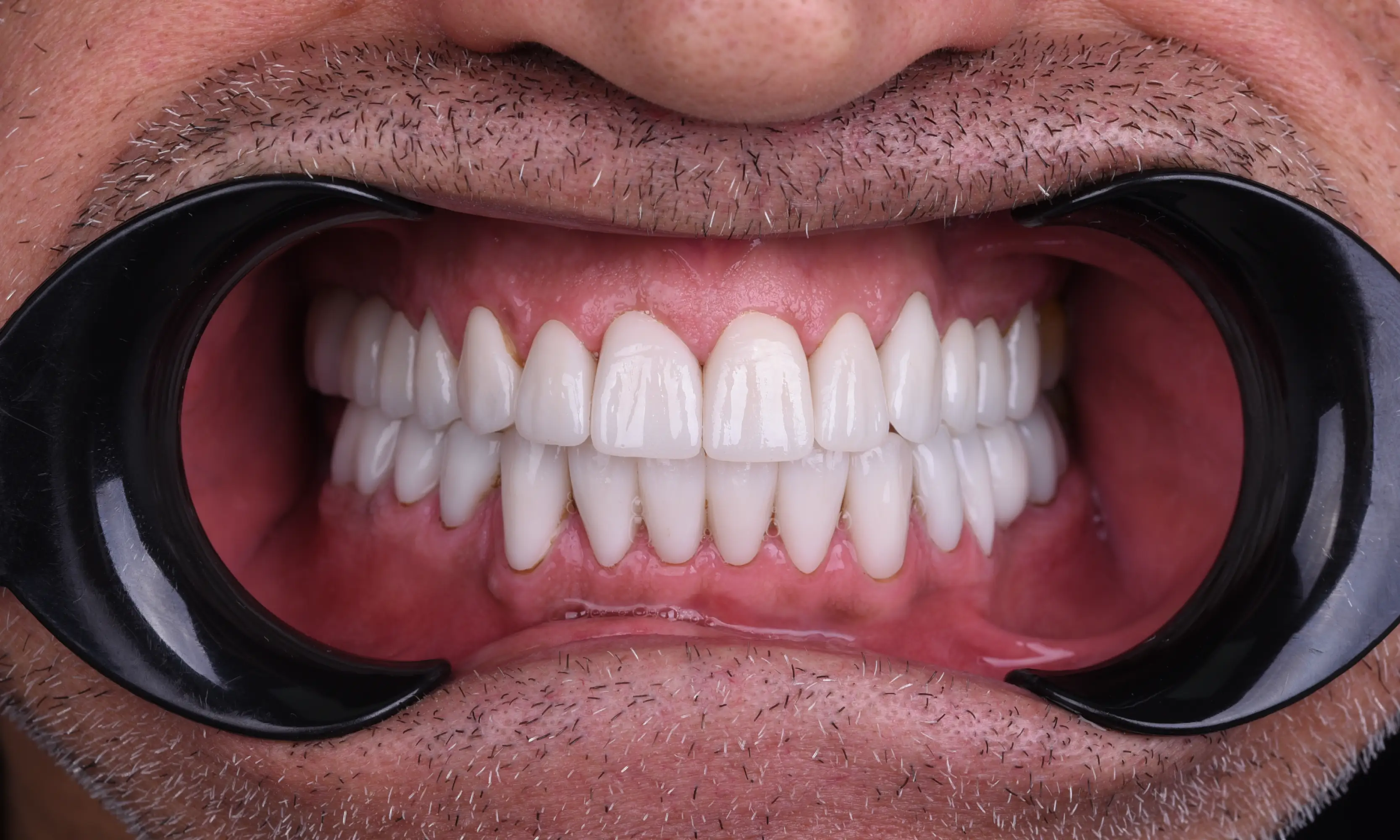 Tam Zirkonyum Sonrası - Vaka 58 - Milim Dental Hospital Bursa