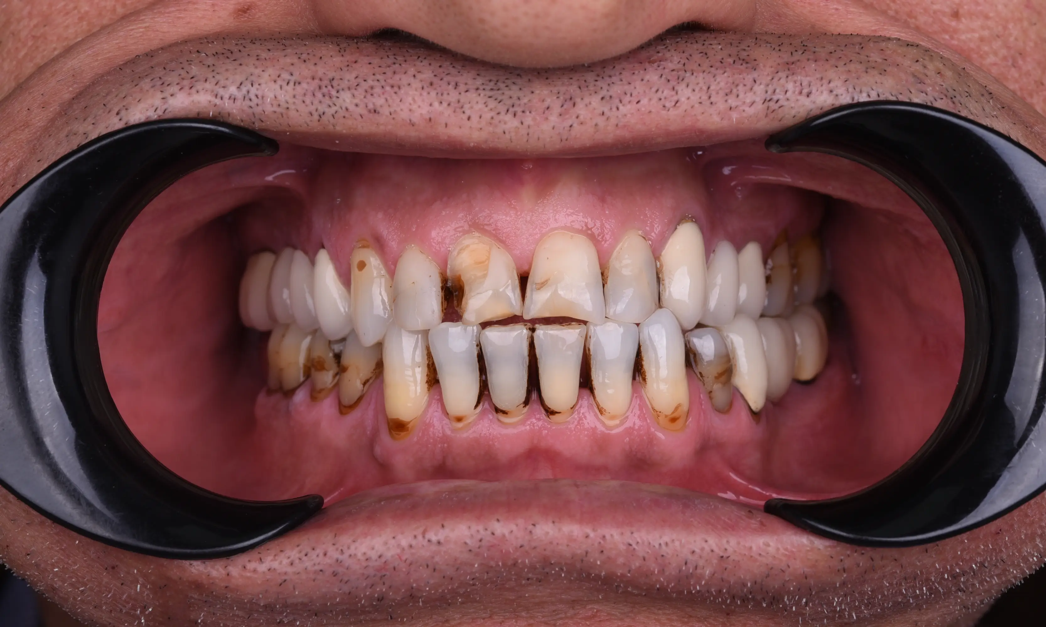 Tam Zirkonyum Öncesi - Vaka 58 - Milim Dental Hospital Bursa