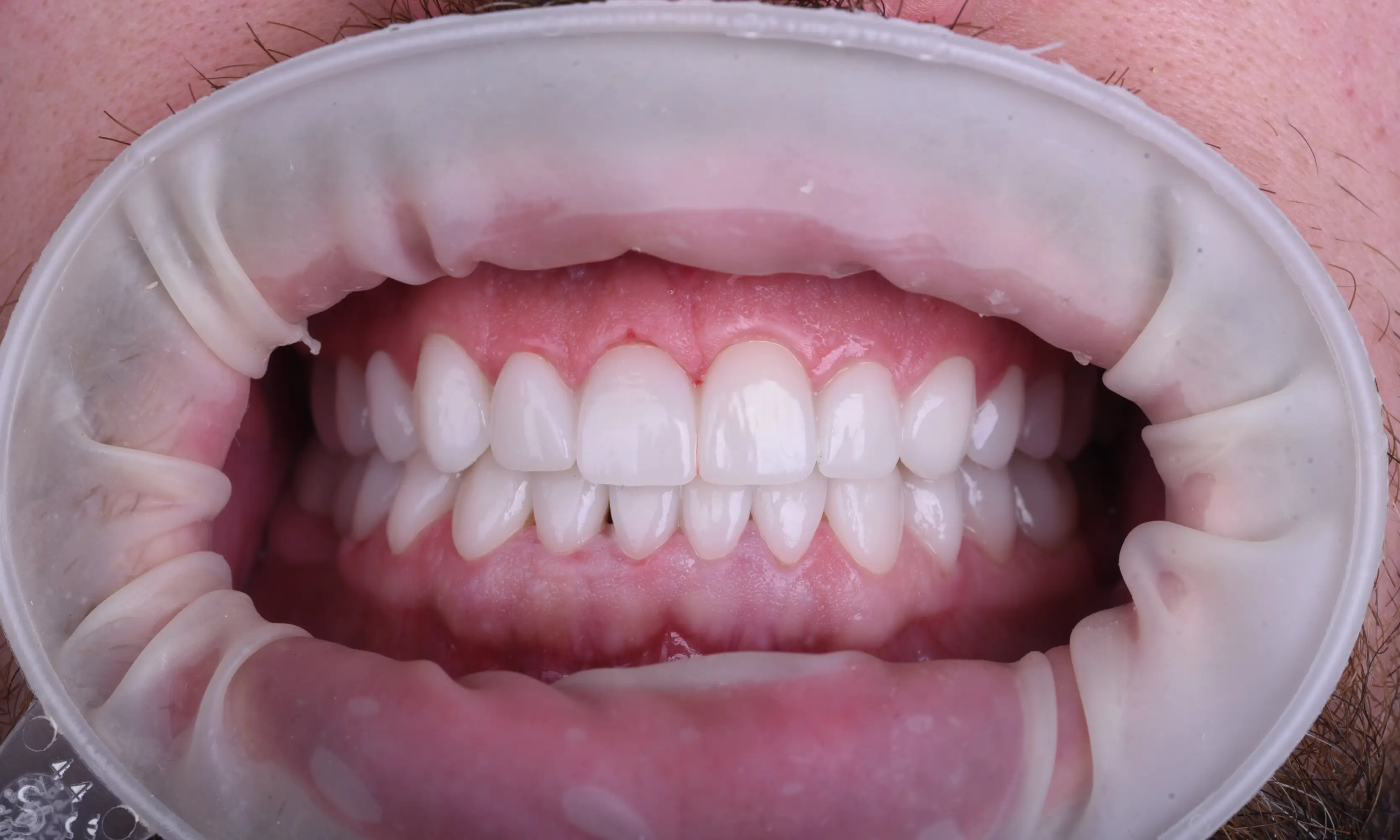 Tam Zirkonyum Sonrası - Vaka 59 - Milim Dental Hospital Bursa