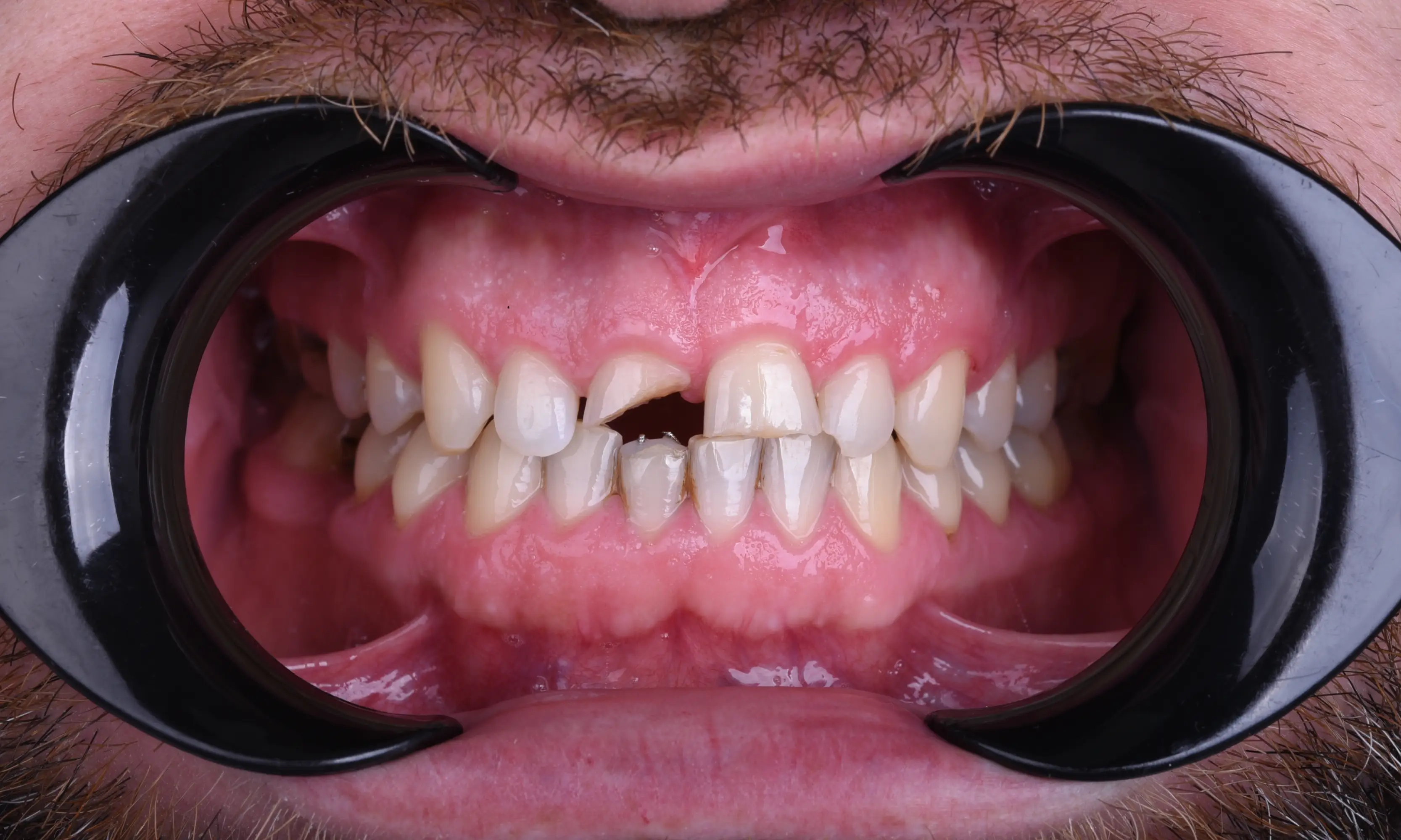 Tam Zirkonyum Öncesi - Vaka 59 - Milim Dental Hospital Bursa