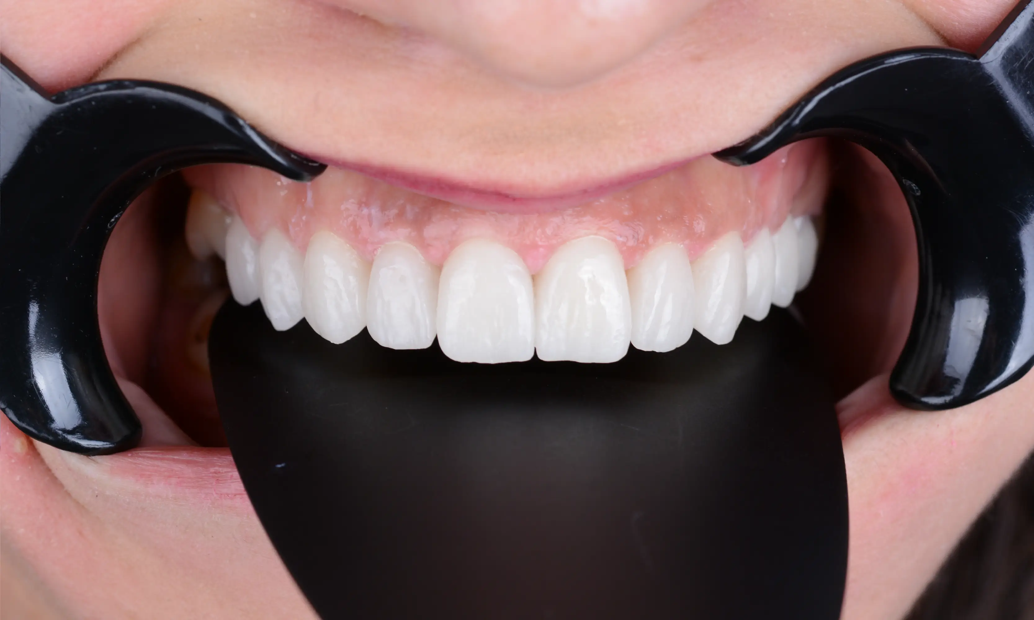 Tam Zirkonyum Sonrası - Vaka 62 - Milim Dental Hospital Bursa